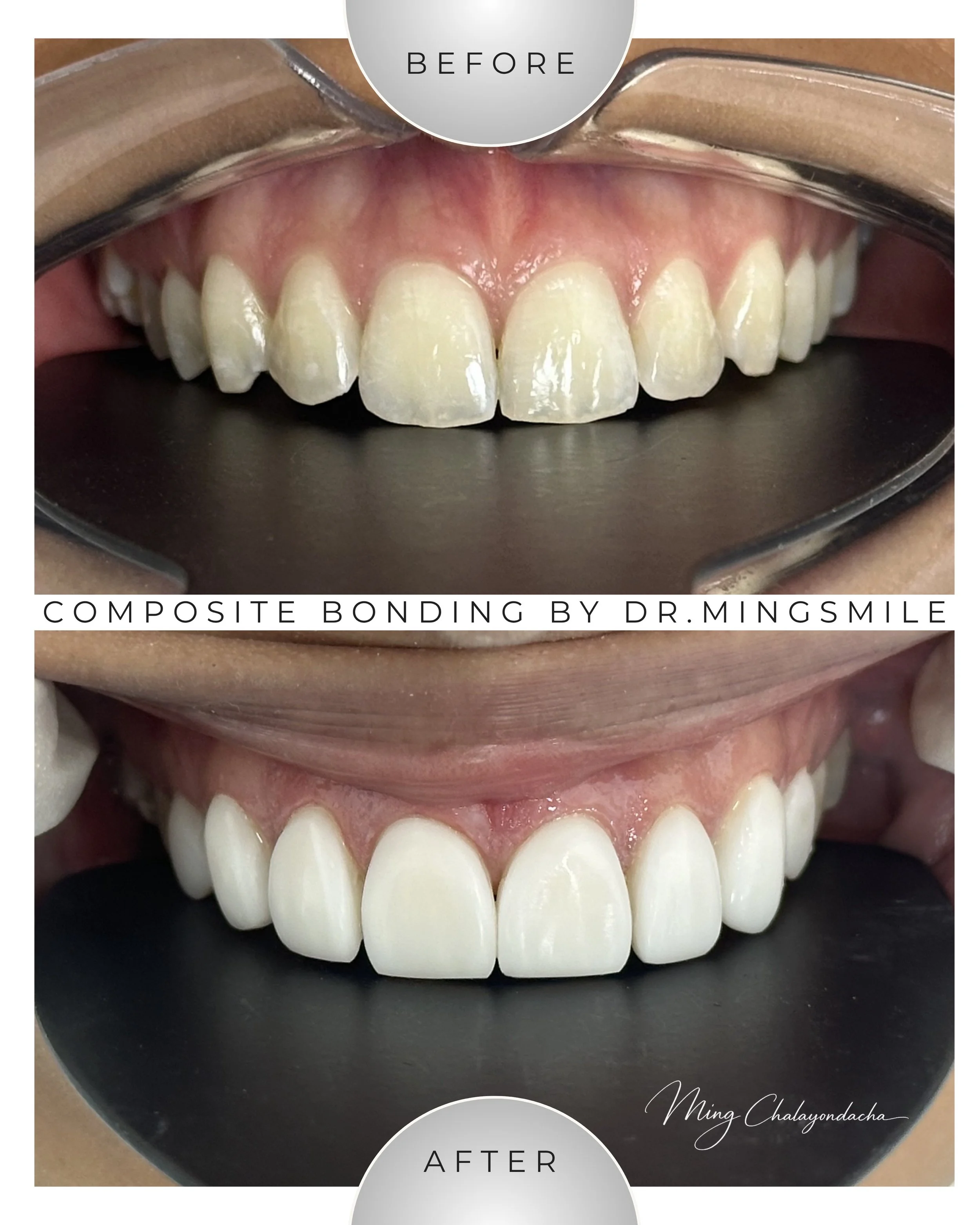 Close-up comparison of teeth before and after composite bonding by Dr. Mingsmile, showing improved appearance and alignment.