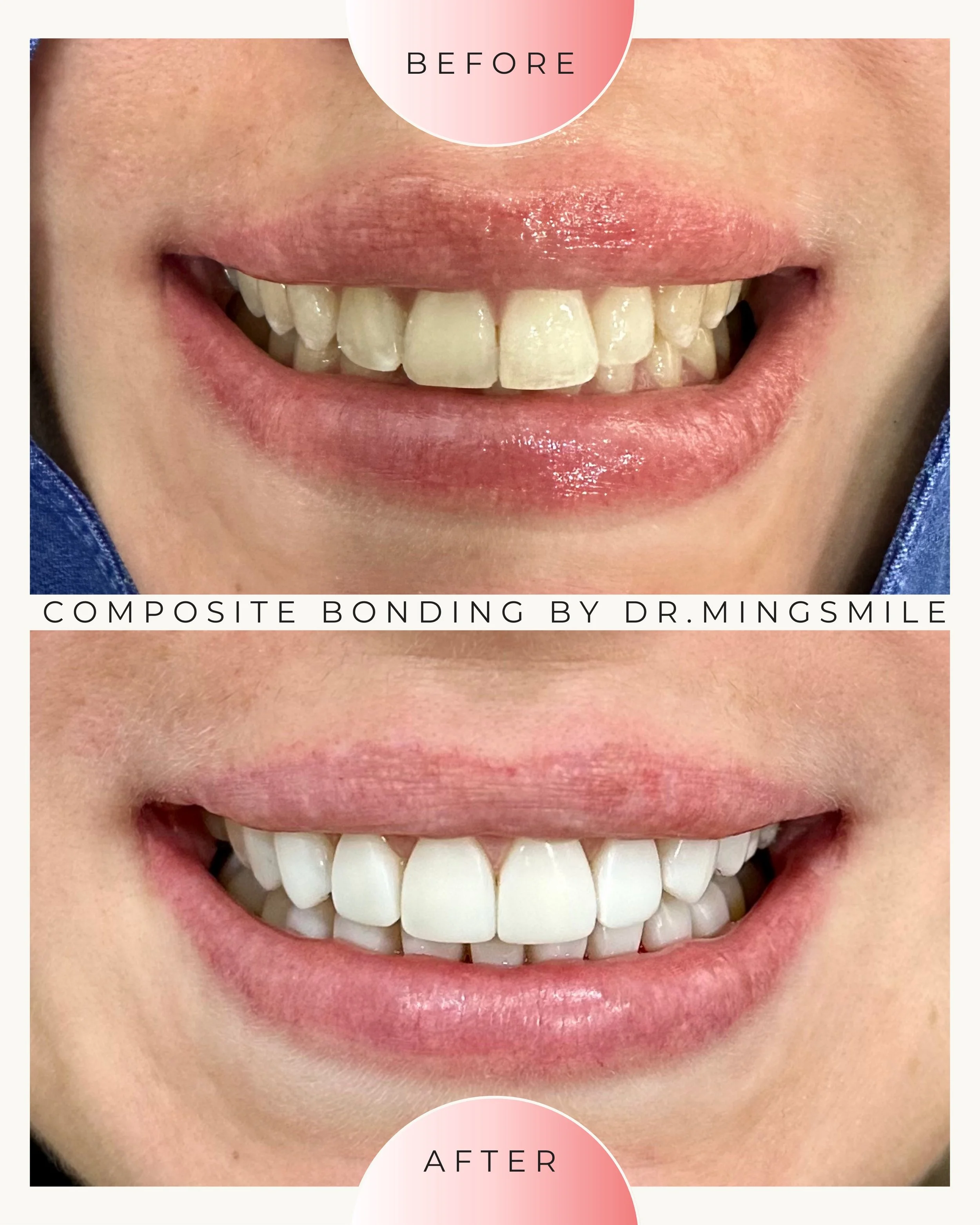 Close-up of a person's smile showing their teeth before and after composite bonding by Dr. Mingsmile, with the 'before' label at the top and the 'after' label at the bottom.