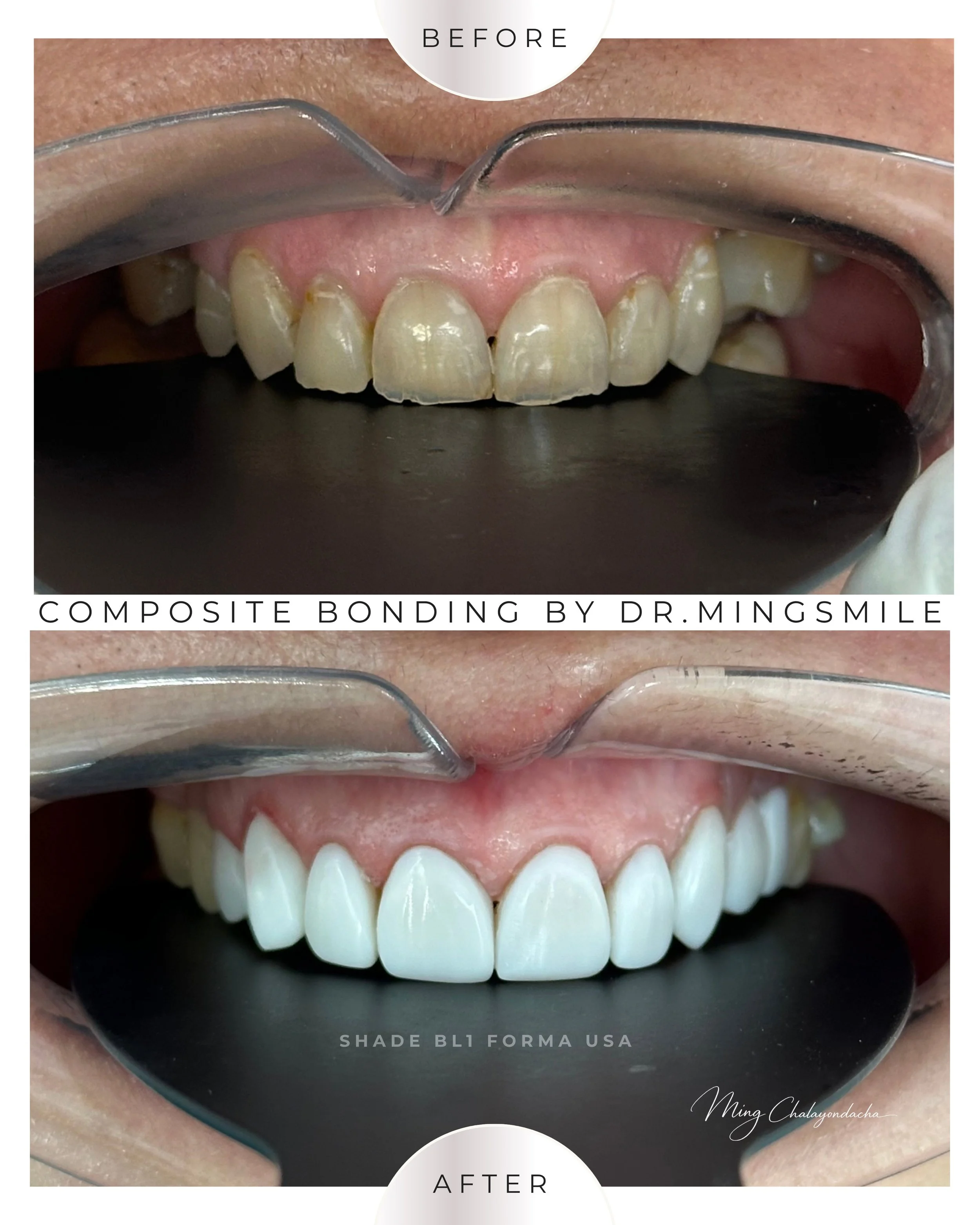 composite bonding  thailand bangkok krabi
