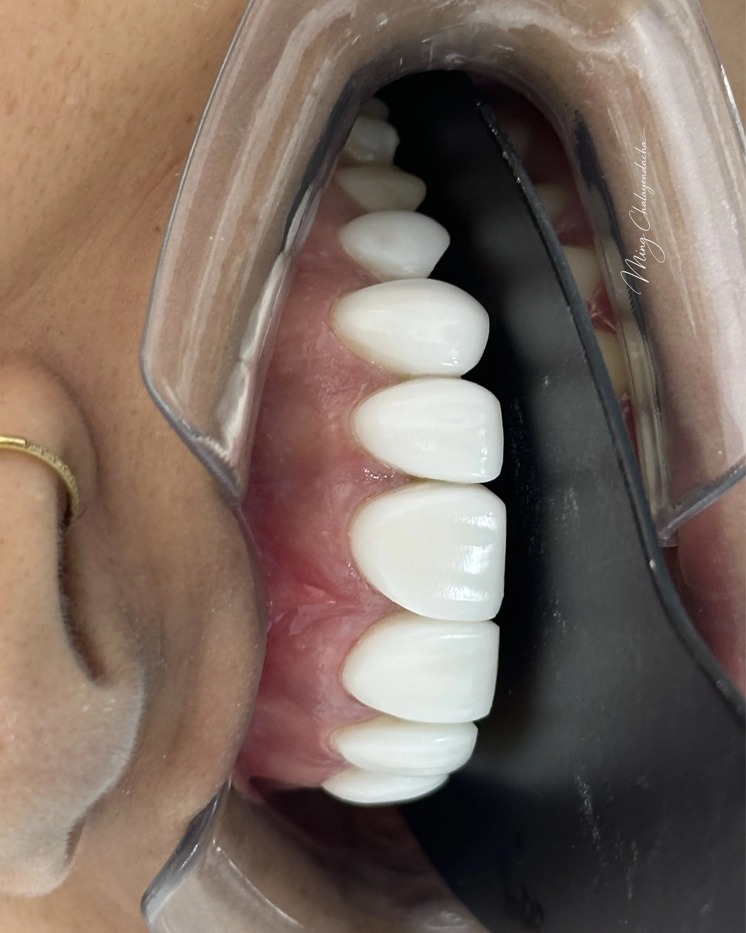 Close-up of a dental mold showing upper teeth with a dark background