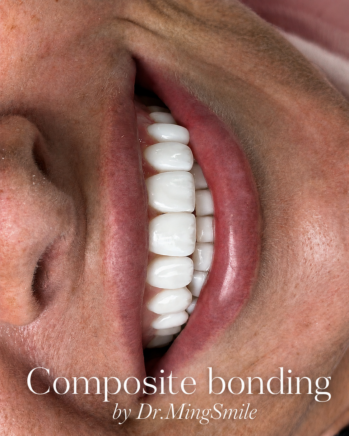 Close-up of a person's open mouth with visible teeth and pink gums, showing dental work with composite bonding on the teeth.