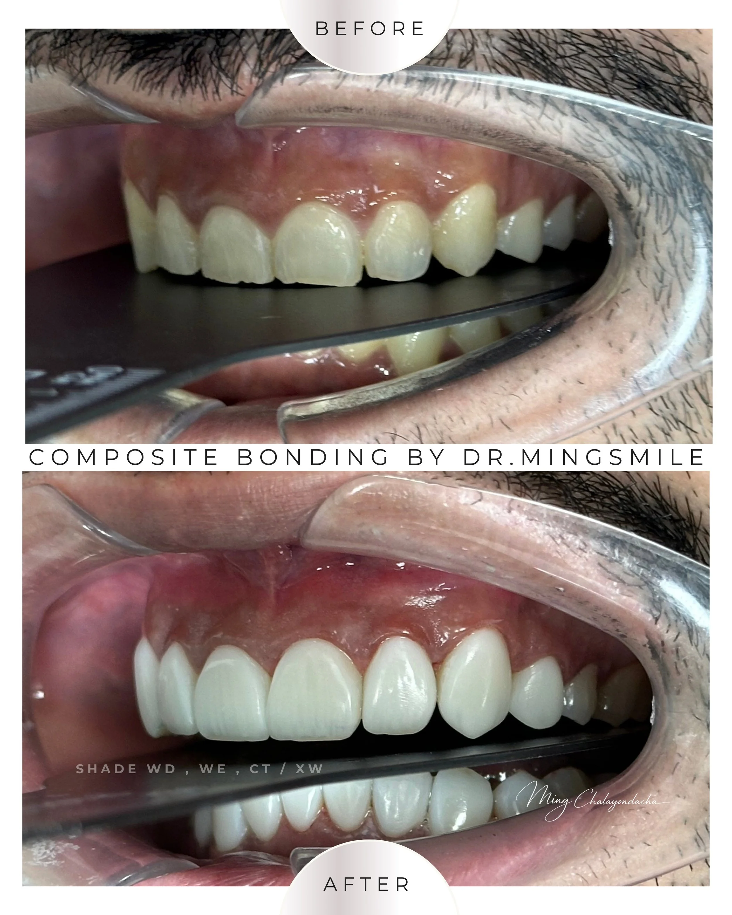composite bonding  thailand bangkok krabi