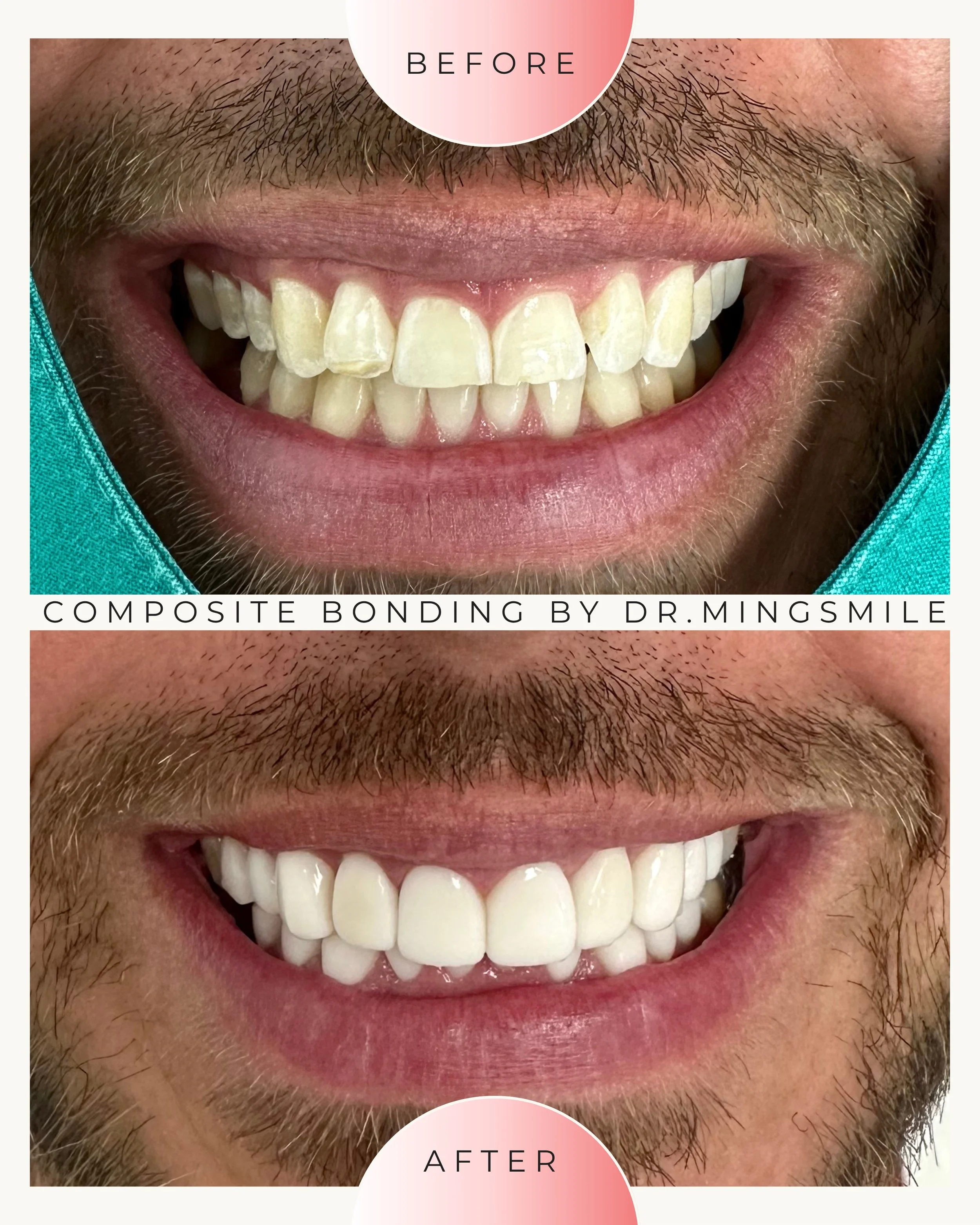 Close-up of a person's smile showing before and after dental composite bonding, with the top image labeled 'Before' and the bottom image labeled 'After'.