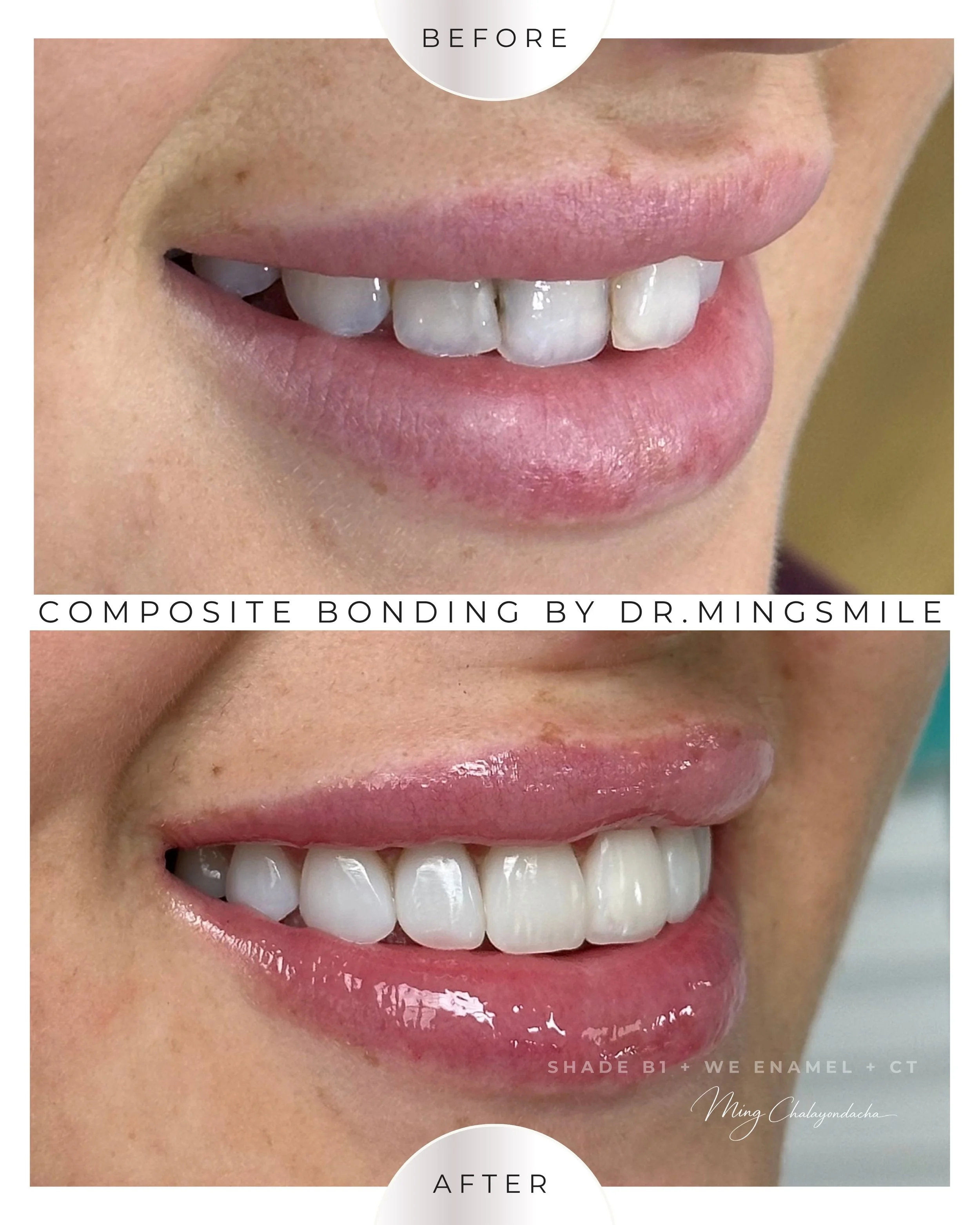 composite bonding 