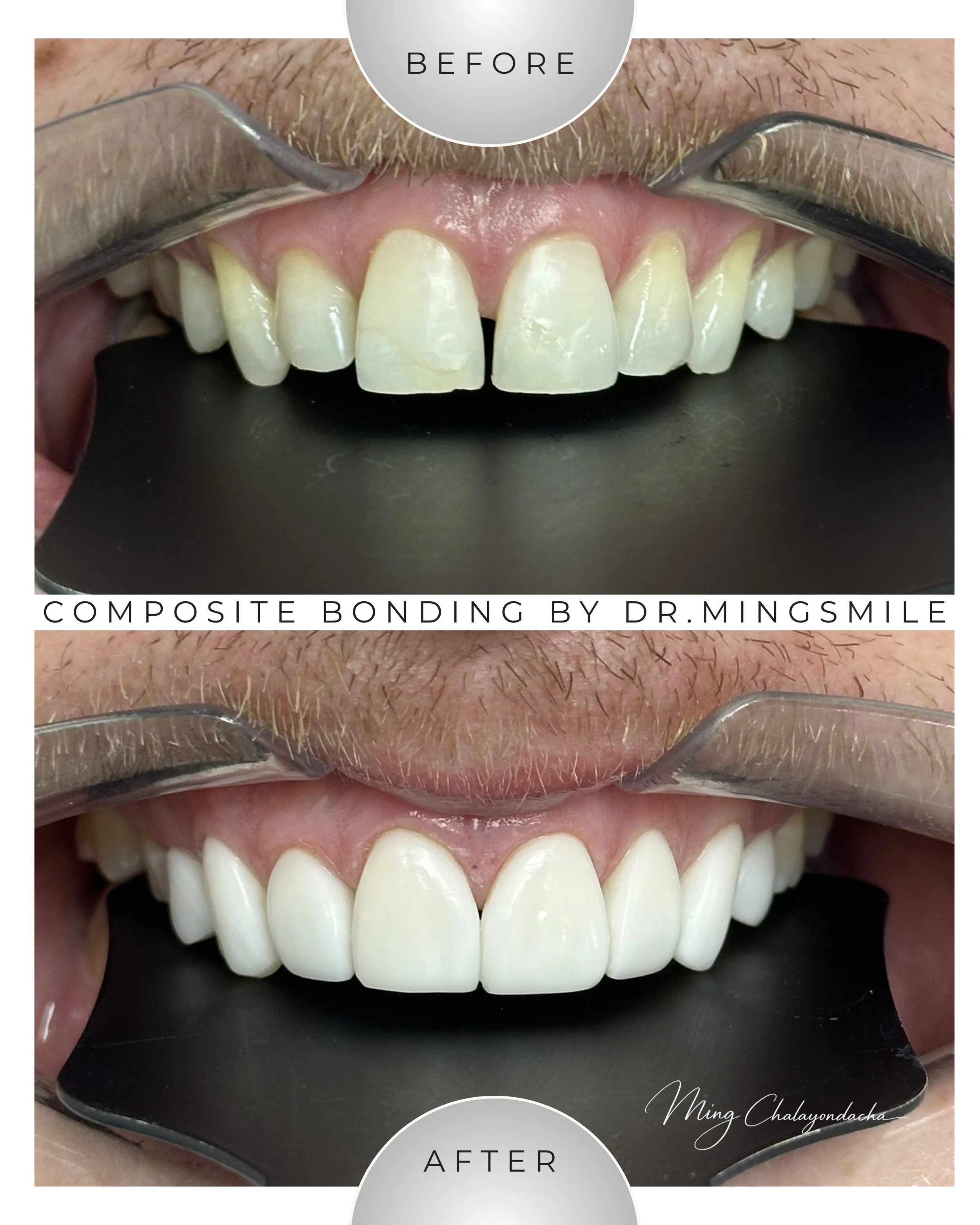 Close-up of a person's teeth before and after dental composite bonding, showing improved appearance after treatment.
