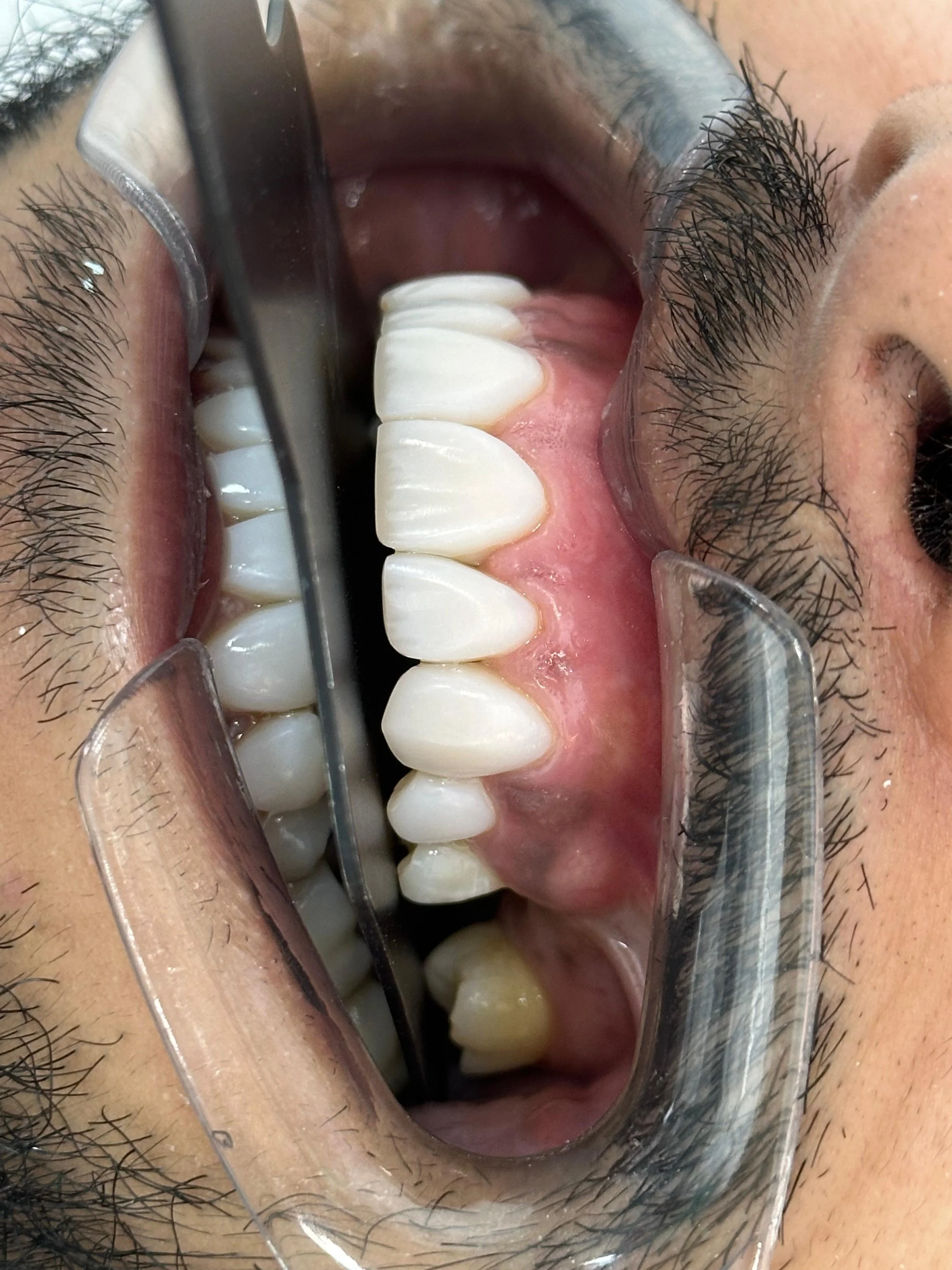 Close-up of a person's open mouth with dental retractors and a dental mirror showing the teeth and gums during dental examination or procedure.