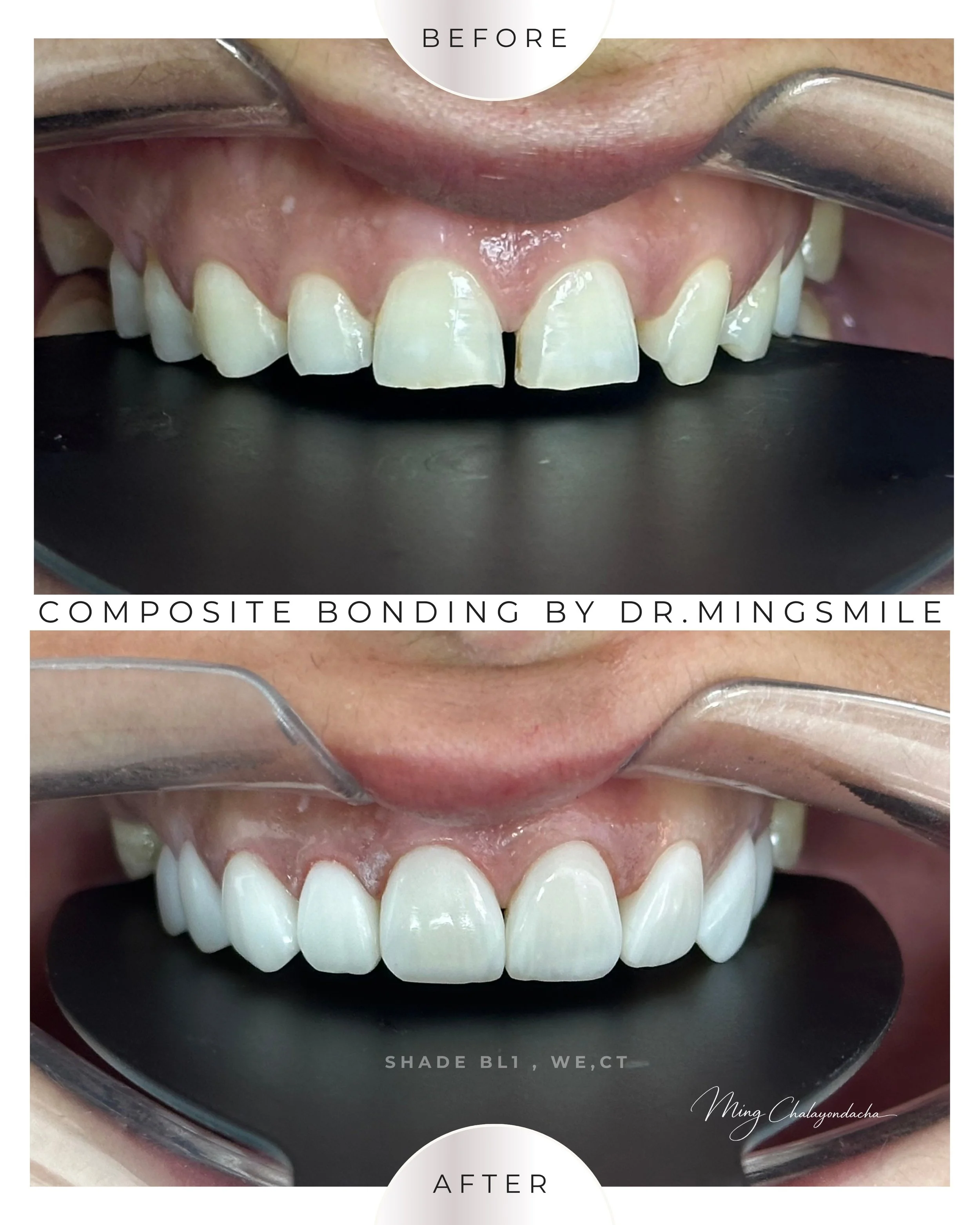 composite bonding  thailand bangkok krabi