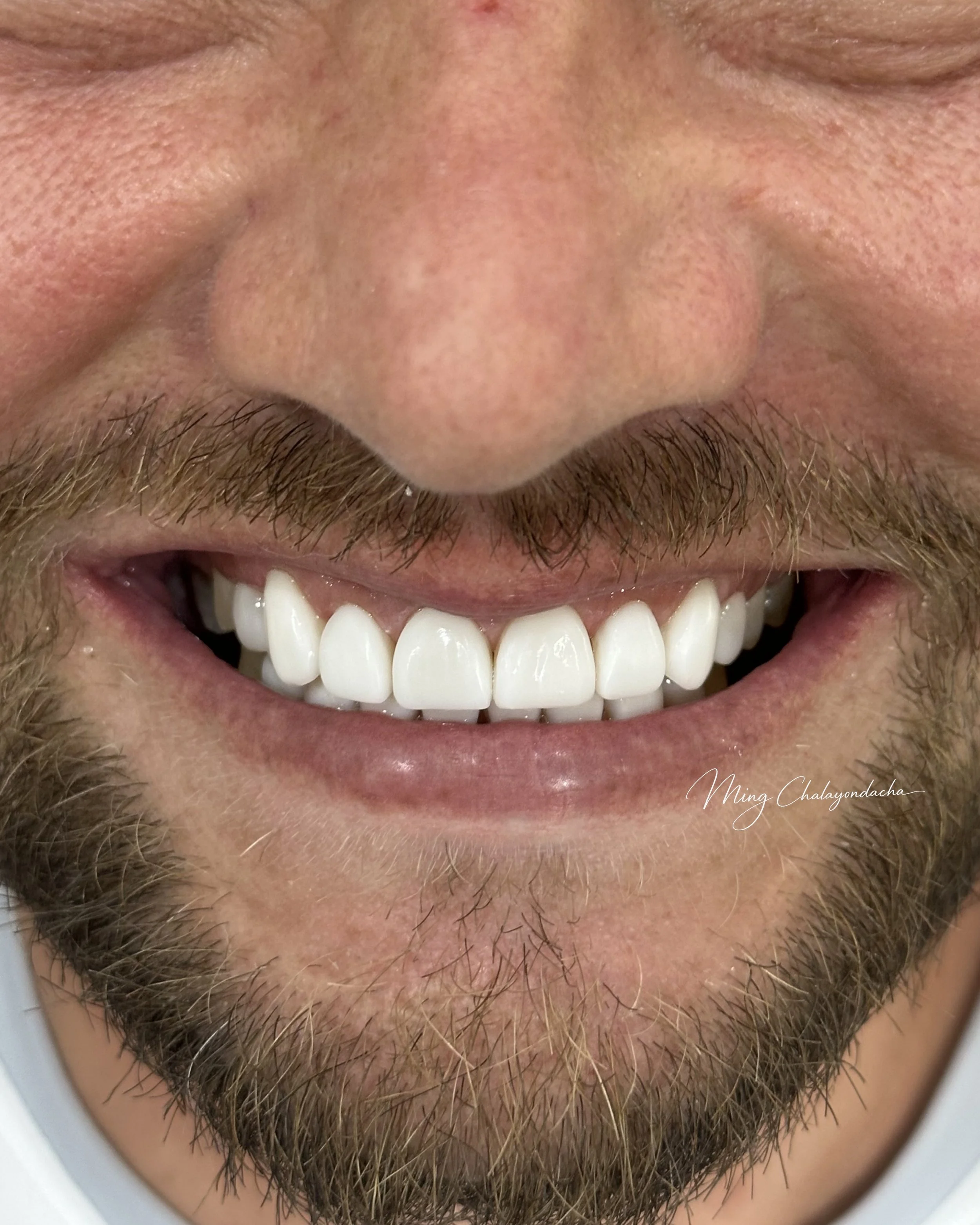 Close-up of a smiling man's mouth showing white teeth, with part of his nose and beard visible.