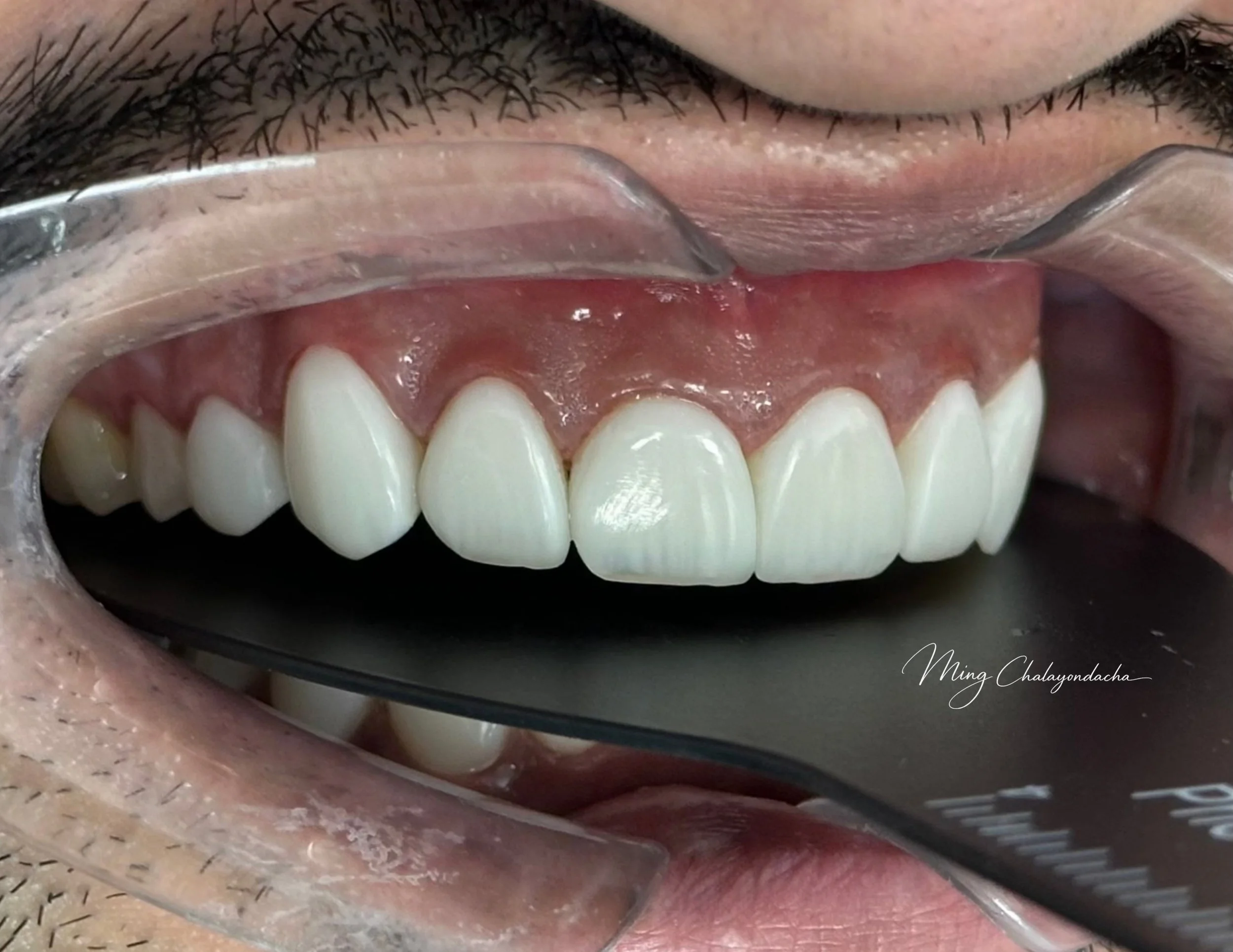 Close-up of a person's mouth with dental retractors, revealing upper teeth and gums, with black facial hair above the upper lip.