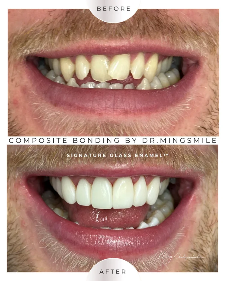 composite bonding transformation