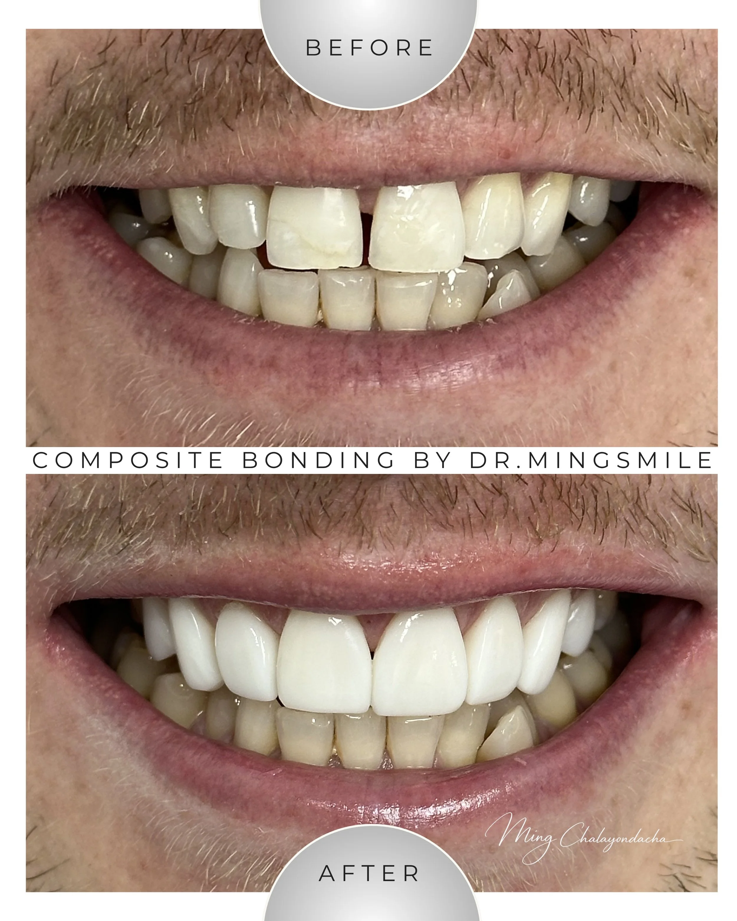 Close-up of a person's smile showing teeth before and after composite bonding, with noticeable improvement in tooth appearance.