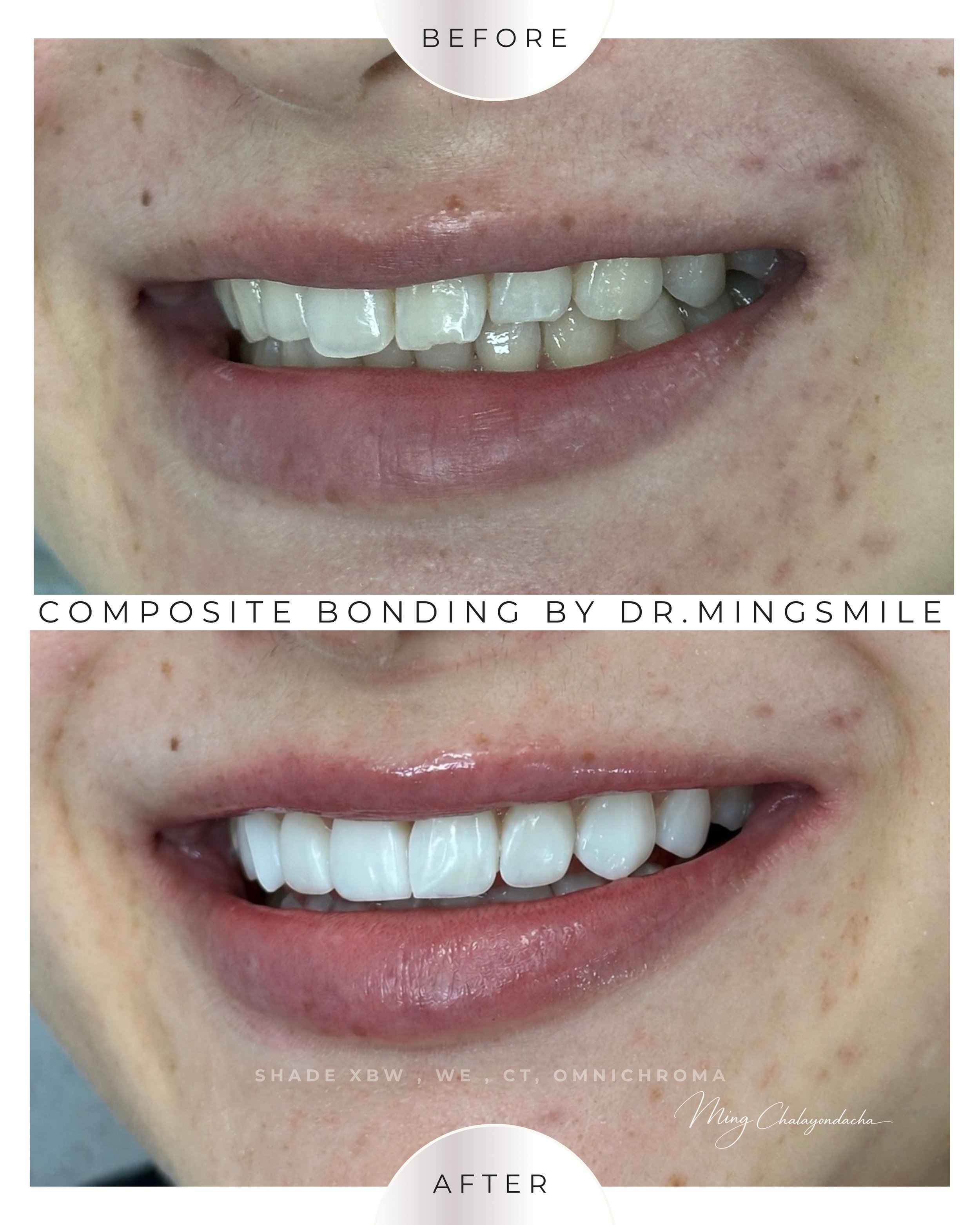 Close-up of a person's smile showing teeth before and after composite bonding procedure by Dr. Mingsmile. The upper image shows teeth with minor imperfections, while the lower image displays a set of well-aligned, whiter teeth.