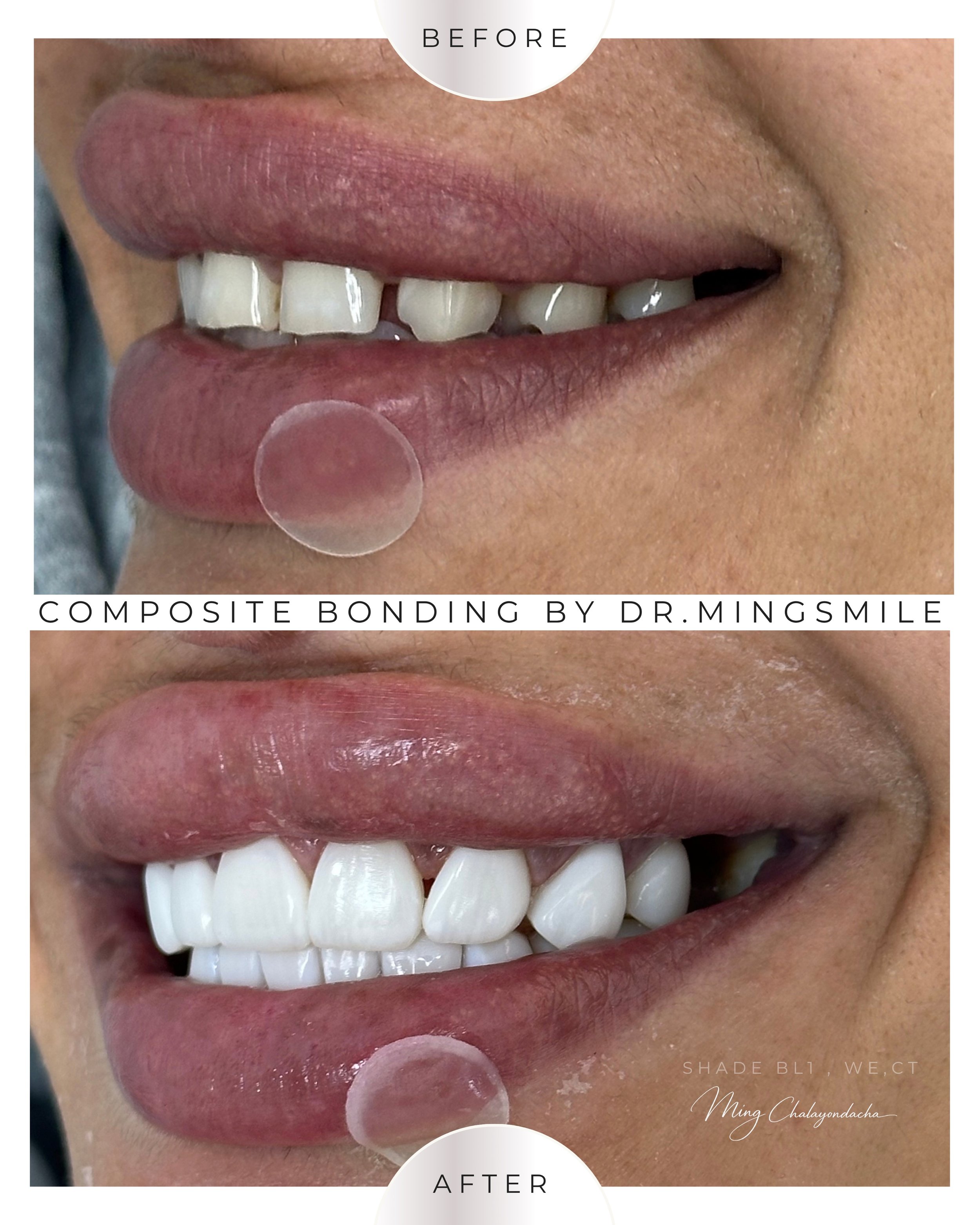 Close-up of a person's smile showing a before and after comparison of dental work, with teeth appearing whiter and more aligned in the after image.