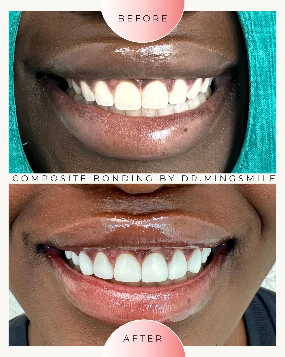 Close-up of a person's mouth showing before and after dental composite bonding treatment by Dr. Mingsmile, with the person smiling broadly.