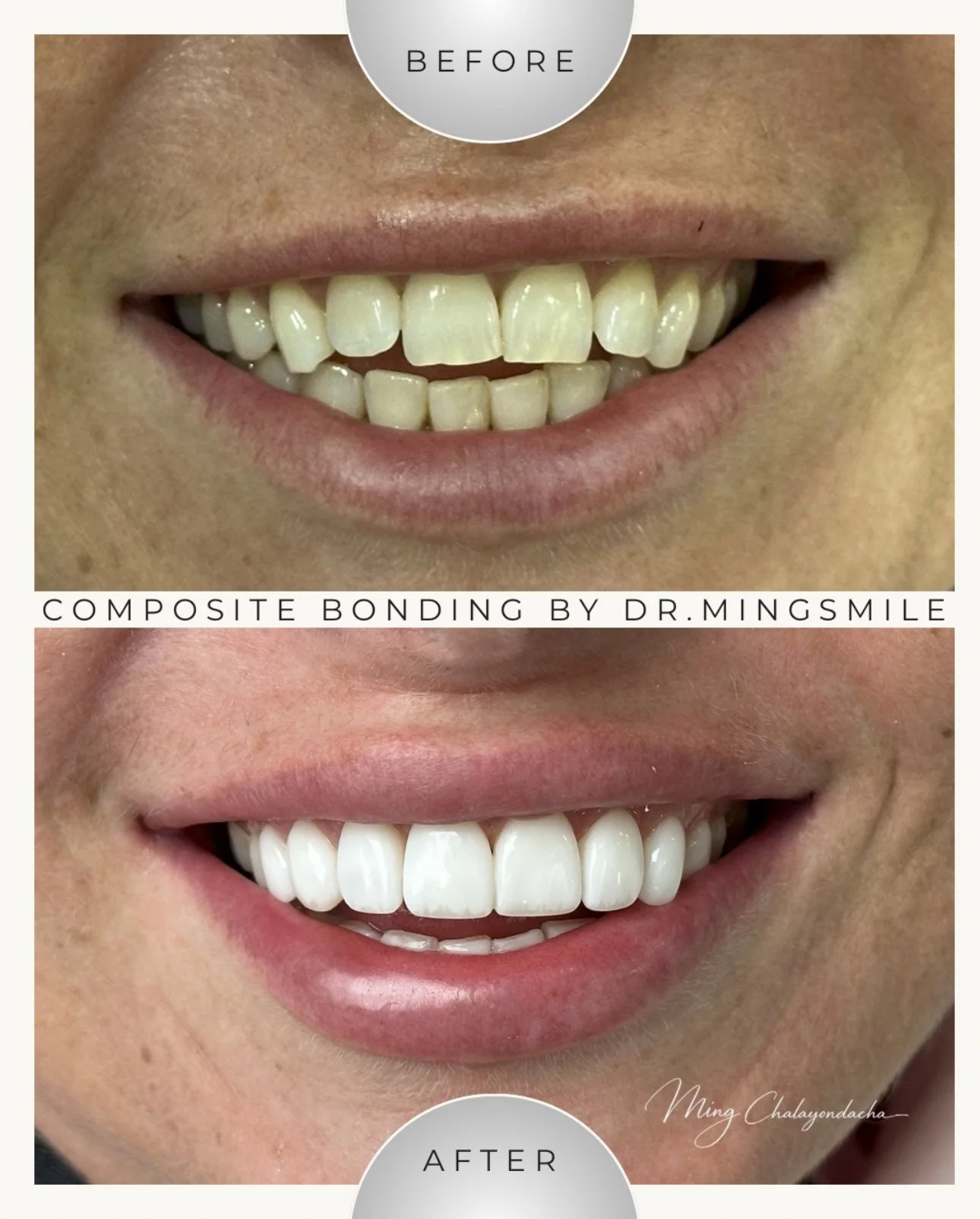 Close-up of a person's smiling mouth showing yellowed, uneven teeth in the 'before' image and bright, straight teeth in the 'after' image following dental composite bonding.