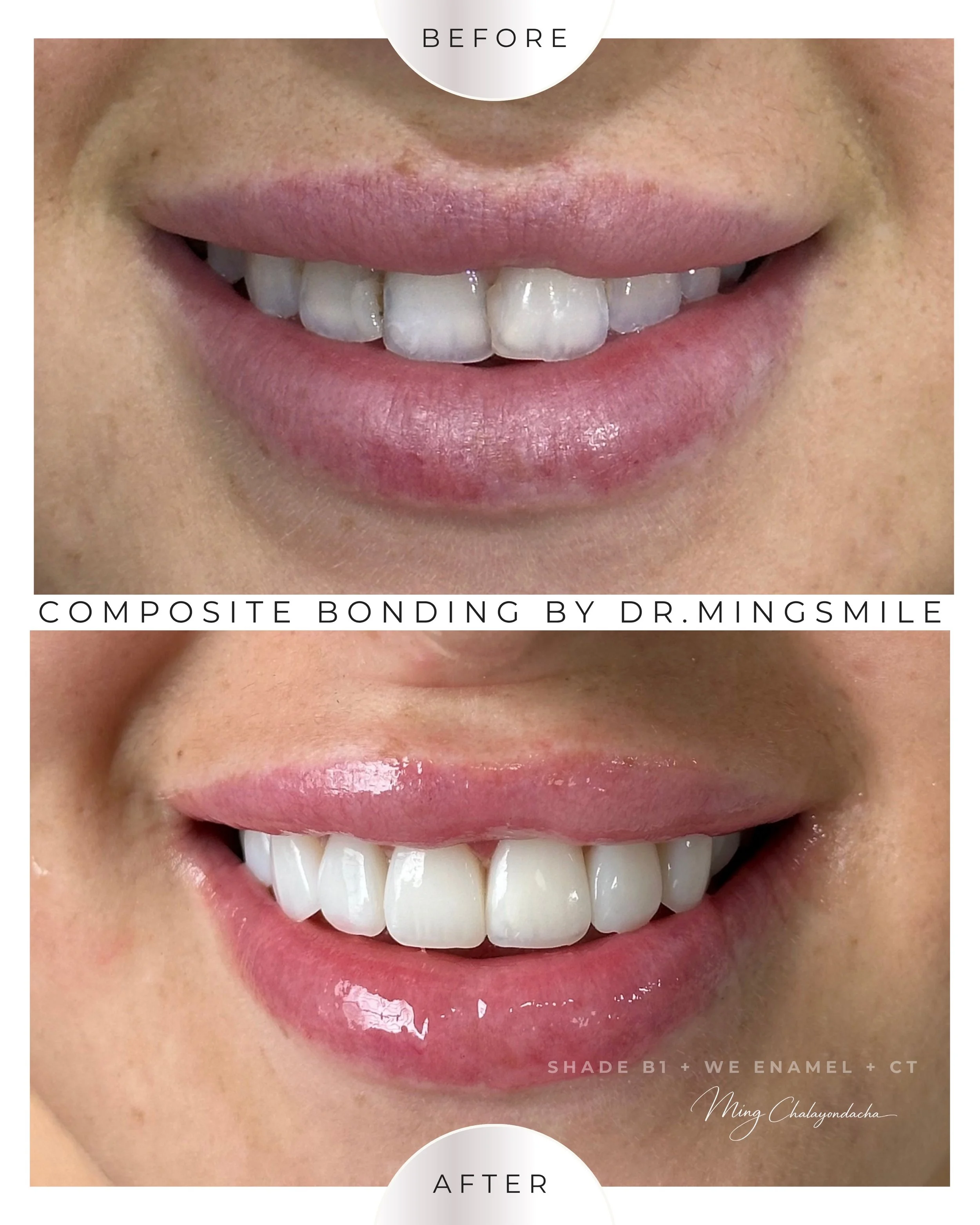 Close-up of a smiling person's mouth showing before and after images of dental bonding. The before image displays chipped, uneven teeth, while the after image shows smooth, even teeth with white enamel.