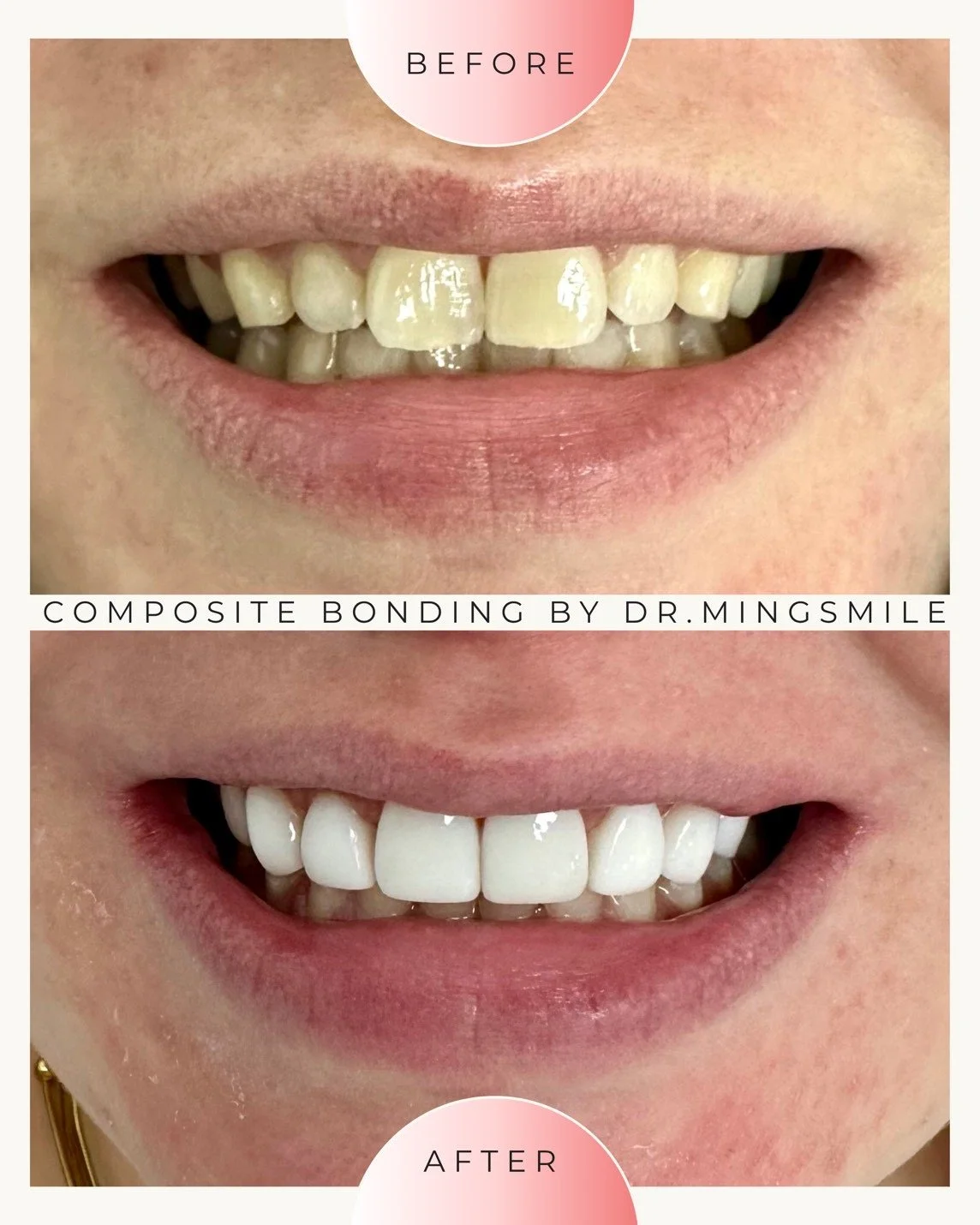 Close-up of a person's smile showing before and after dental bonding. The top photo shows discolored, chipped, and uneven teeth, while the bottom photo shows teeth that are whiter, smoother, and more even.