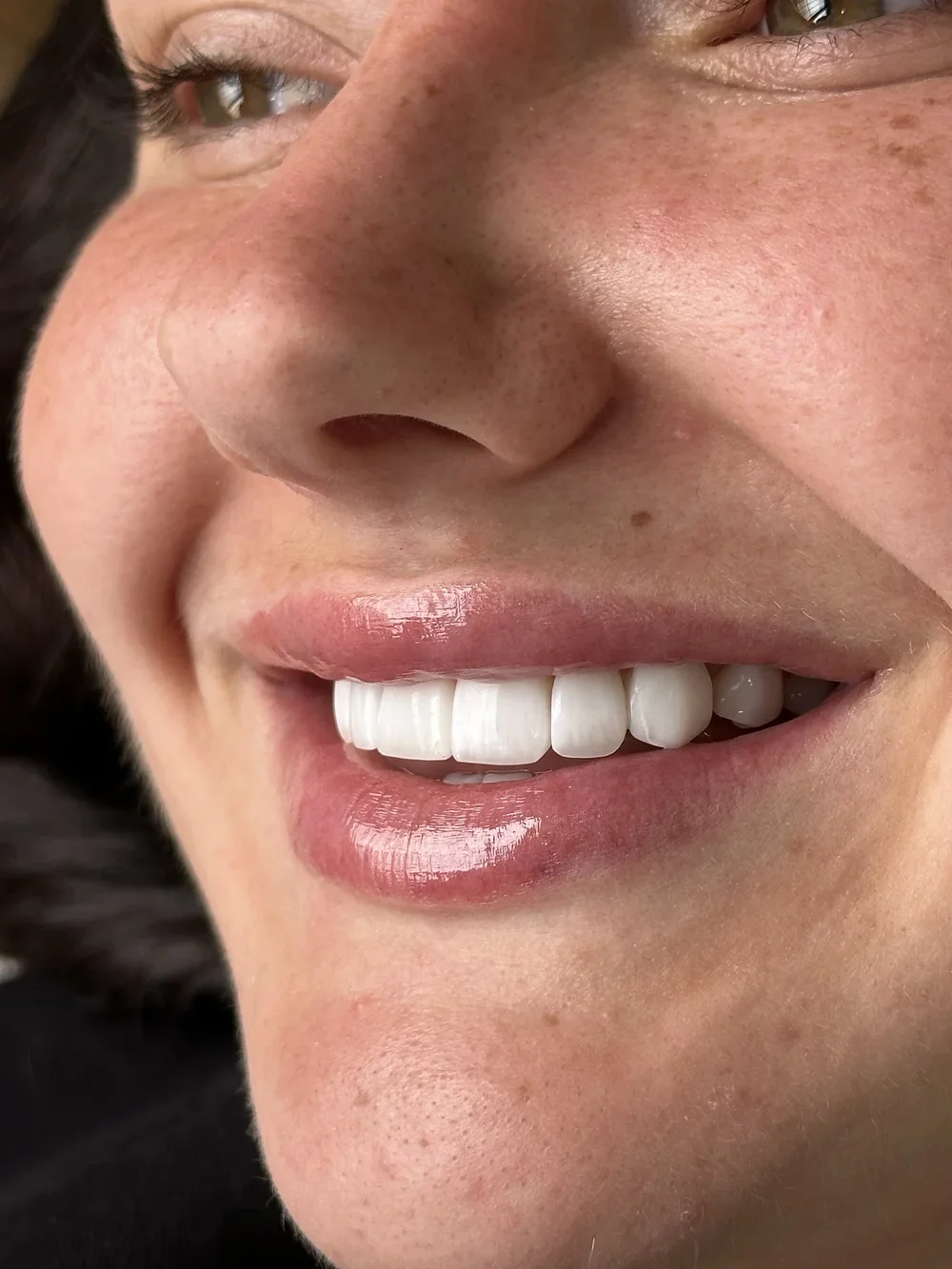 Close-up of a woman's face showcasing a bright smile with white teeth, pink lips, and freckles.