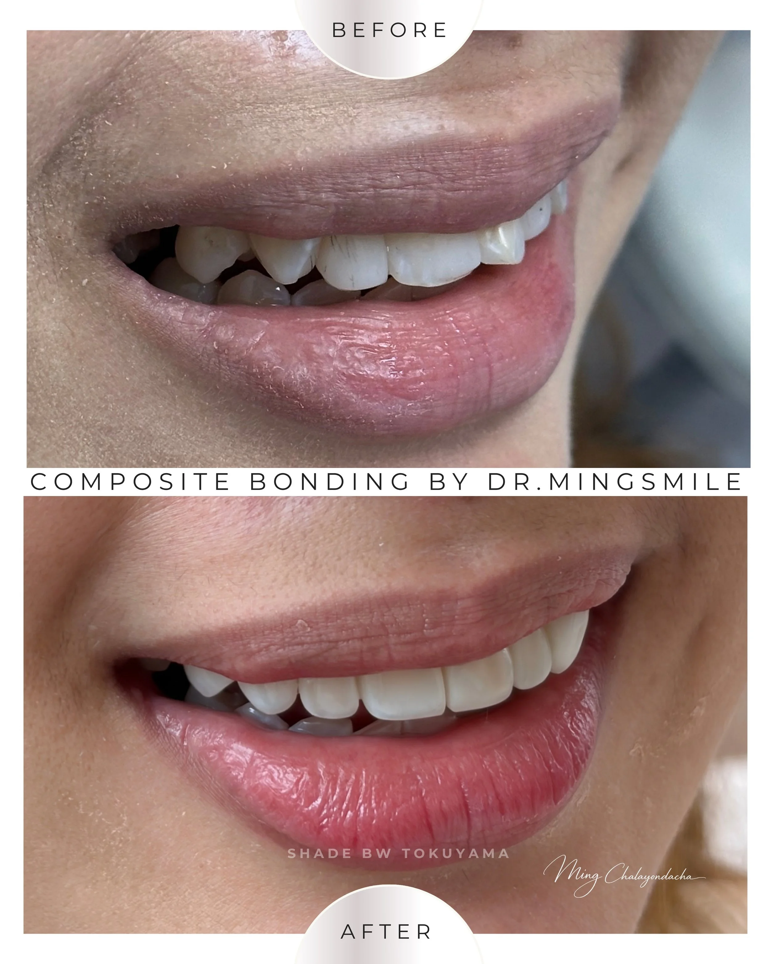 composite bonding  thailand bangkok krabi