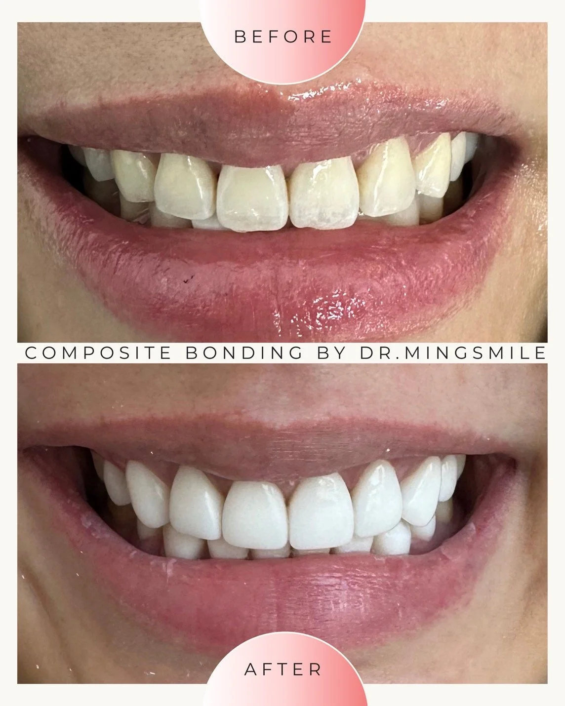 Close-up comparison of a person's teeth before and after dental composite bonding, showing improved whiteness and alignment.