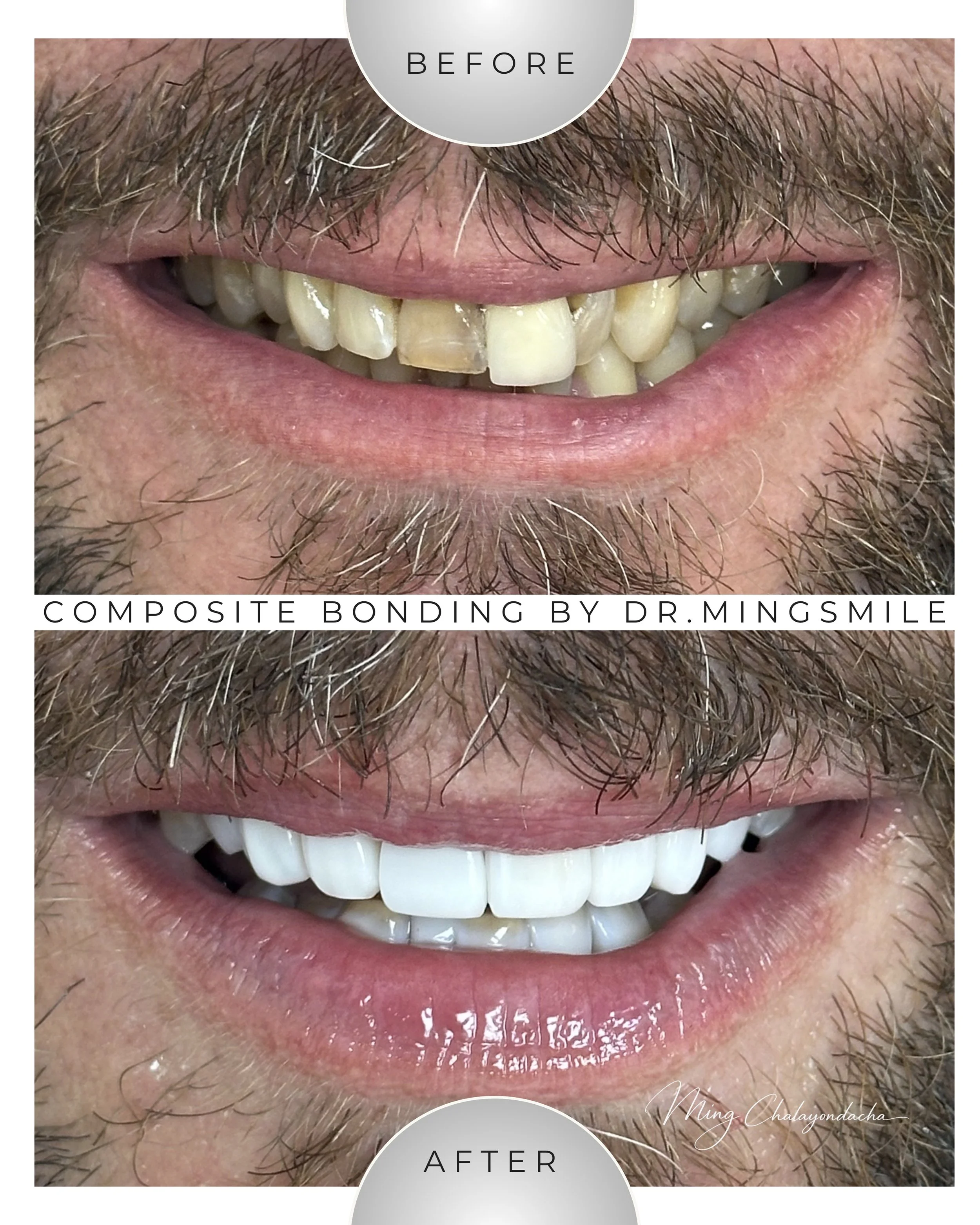 Close-up of a person's smile showing a before and after comparison of dental bonding. The before side shows stained, chipped teeth, and the after side shows clean, white, even teeth.