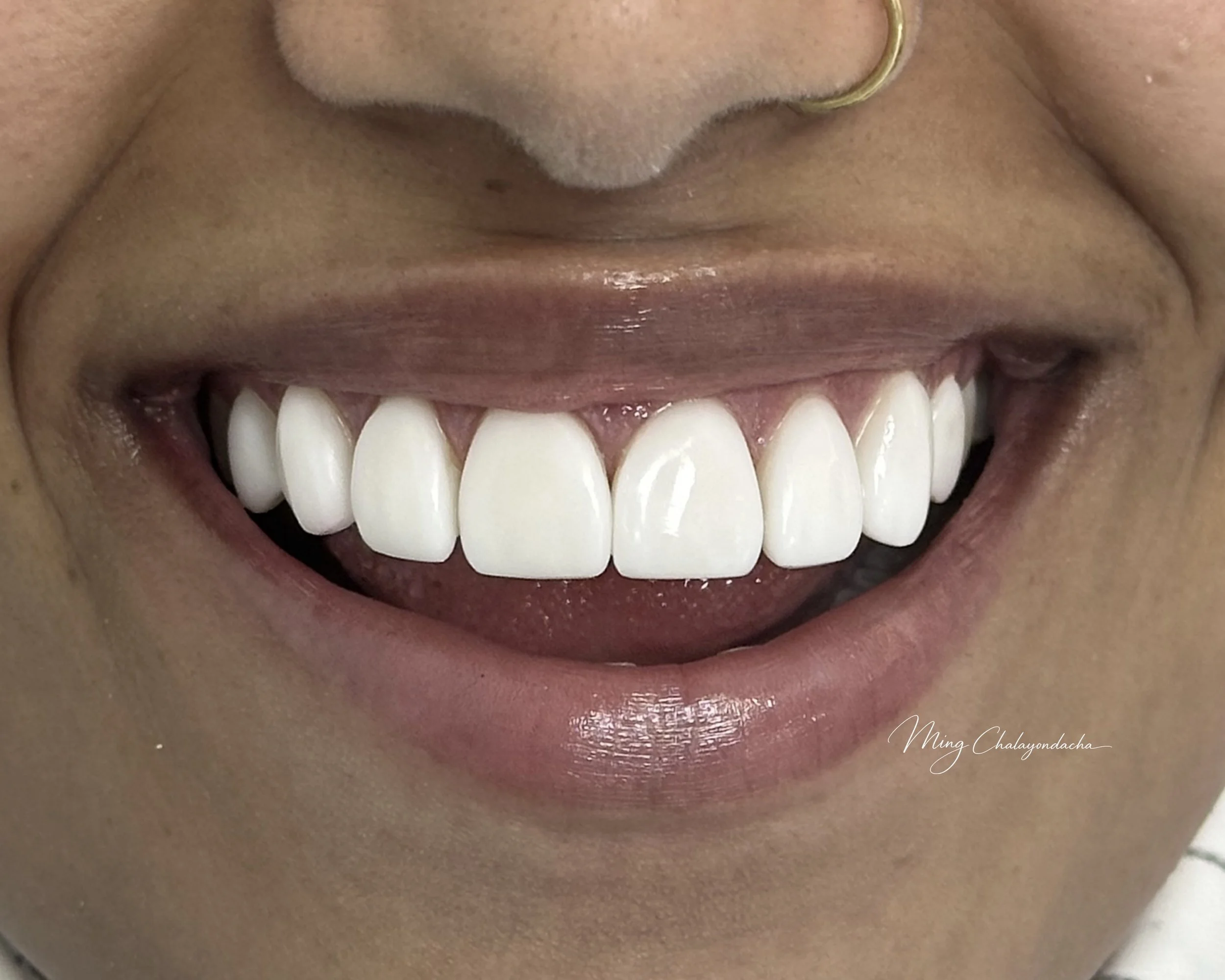 Close-up of a person's smile showing their upper teeth, lips, and part of their nose with a nose ring.