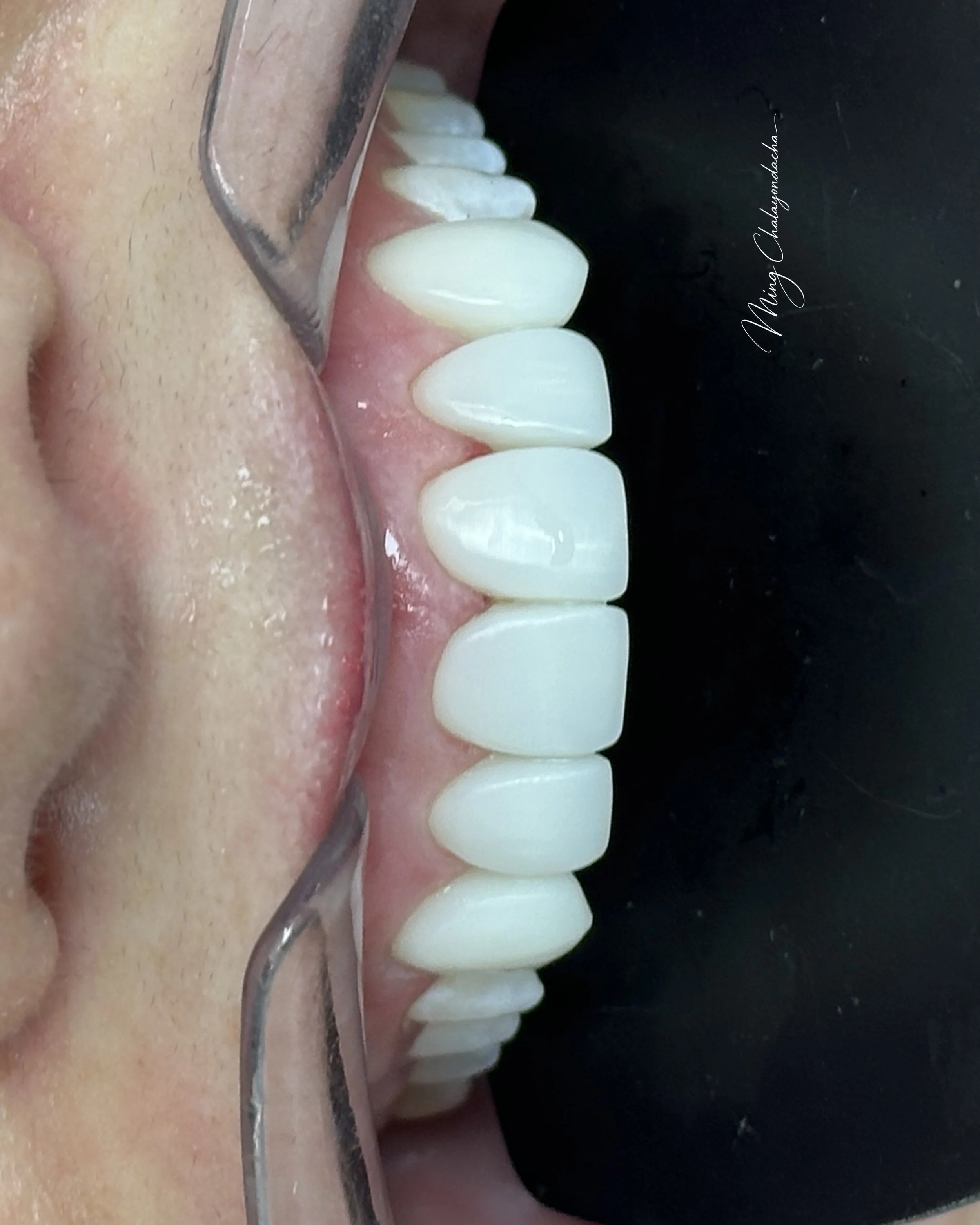 Close-up of a dental impression mold showing white teeth and gums.