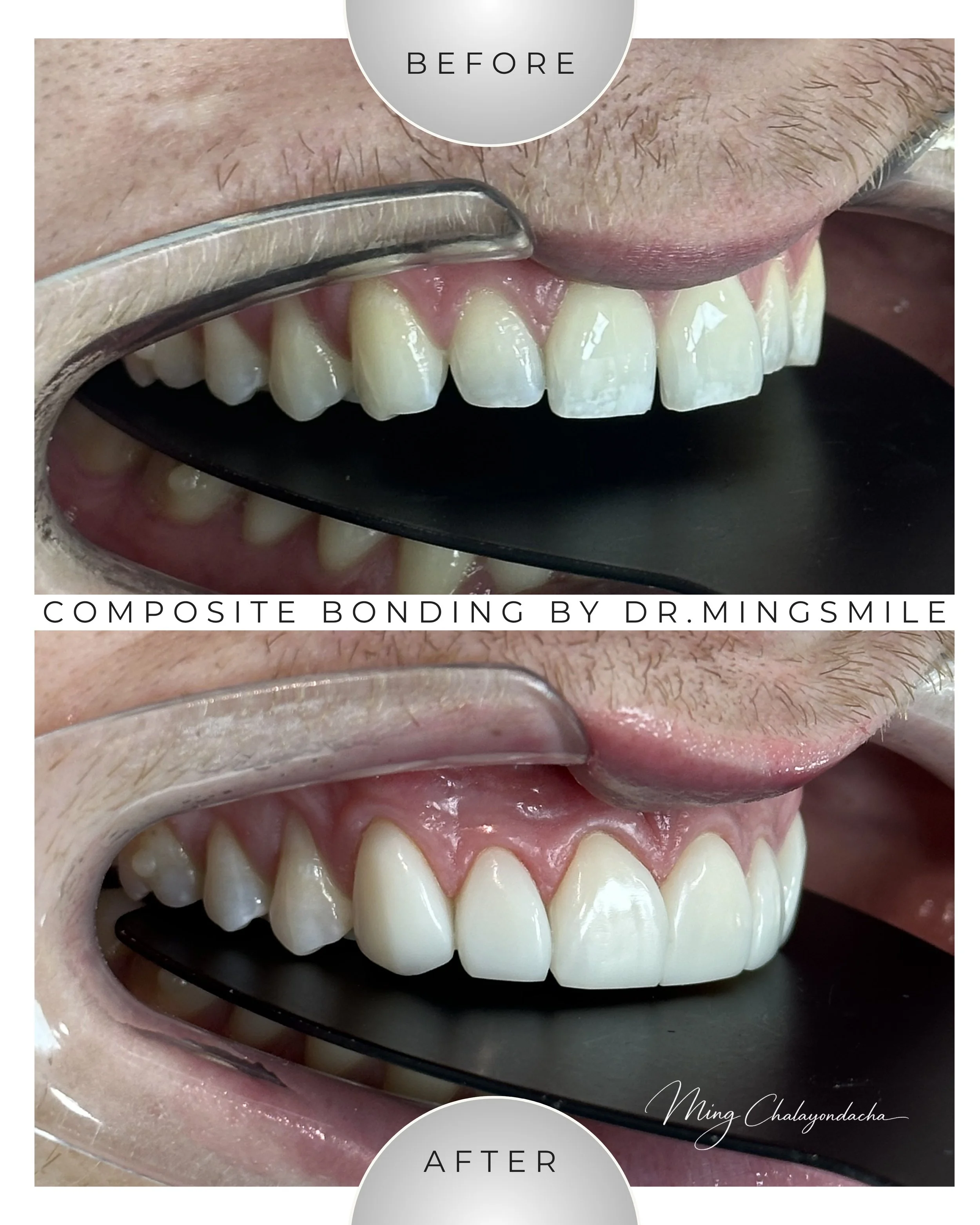 Close-up of a person's mouth showing a dental procedure before and after a composite bonding treatment, with visible improvement in the appearance of teeth.