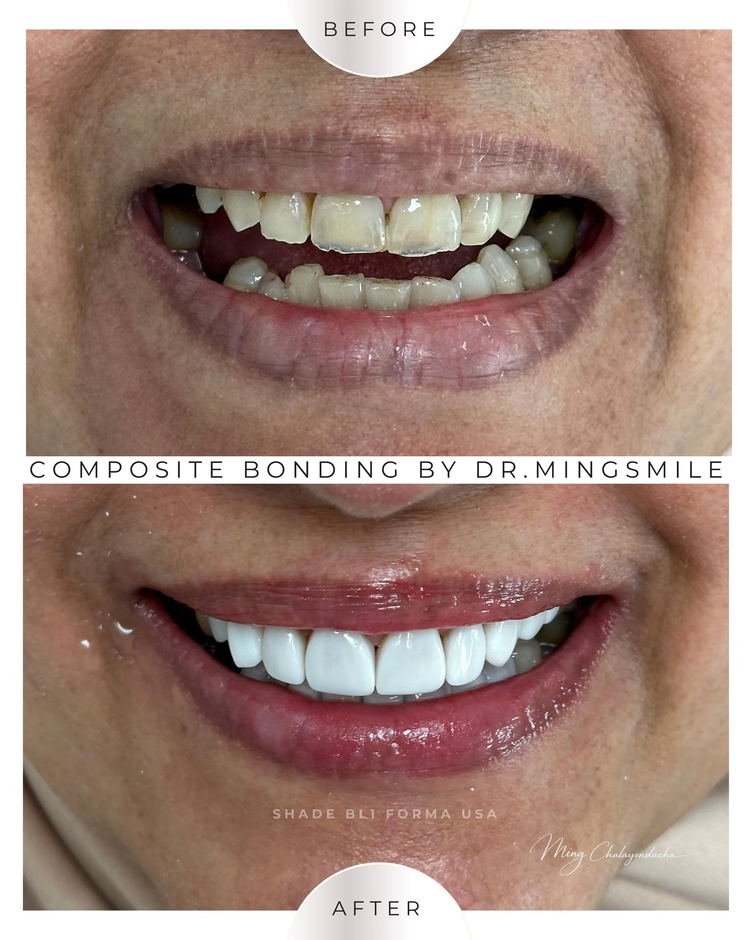 composite bonding  thailand bangkok krabi