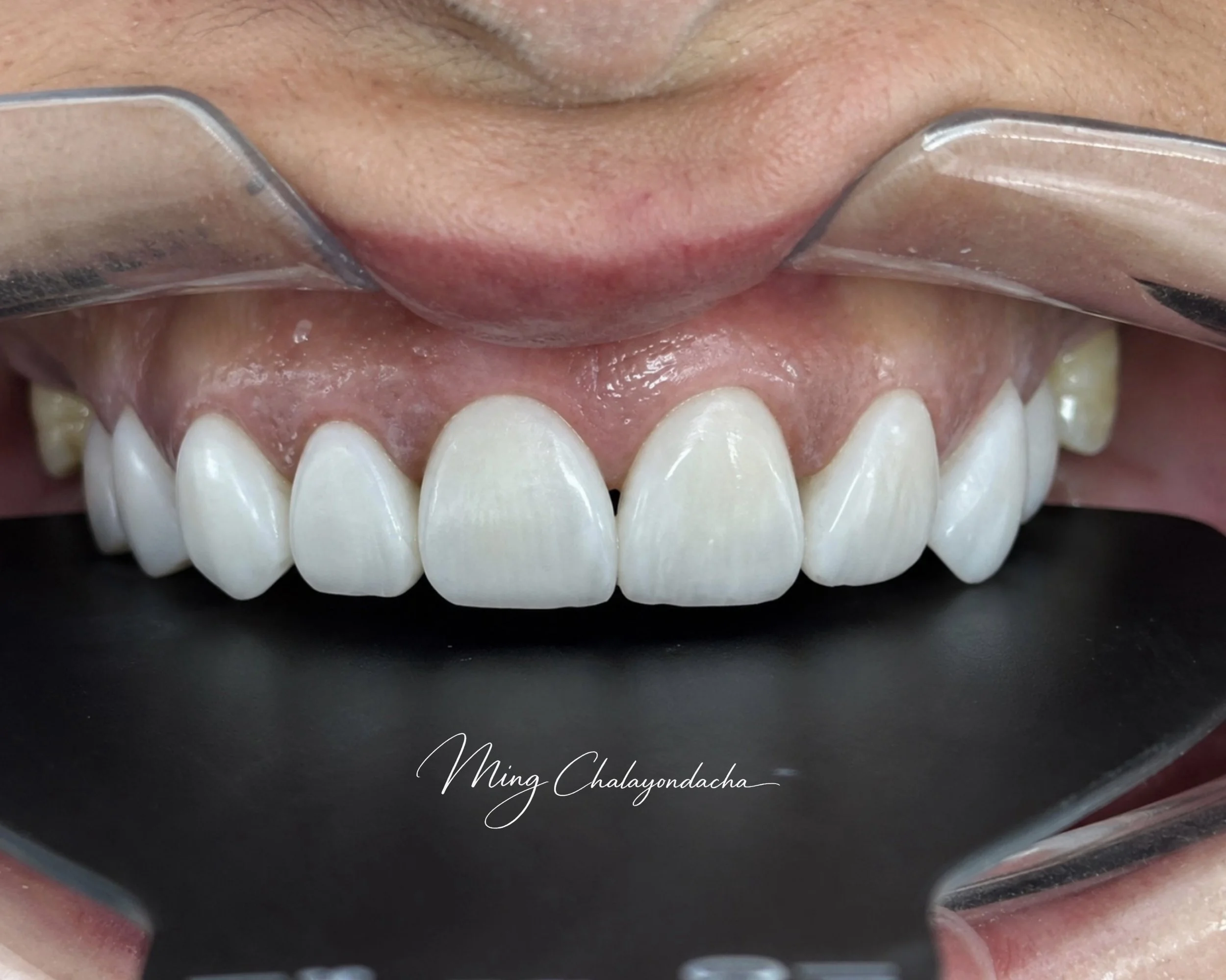 Close-up of a person's mouth with a dental mirror reflecting the upper teeth, showing well-aligned white teeth and gums.