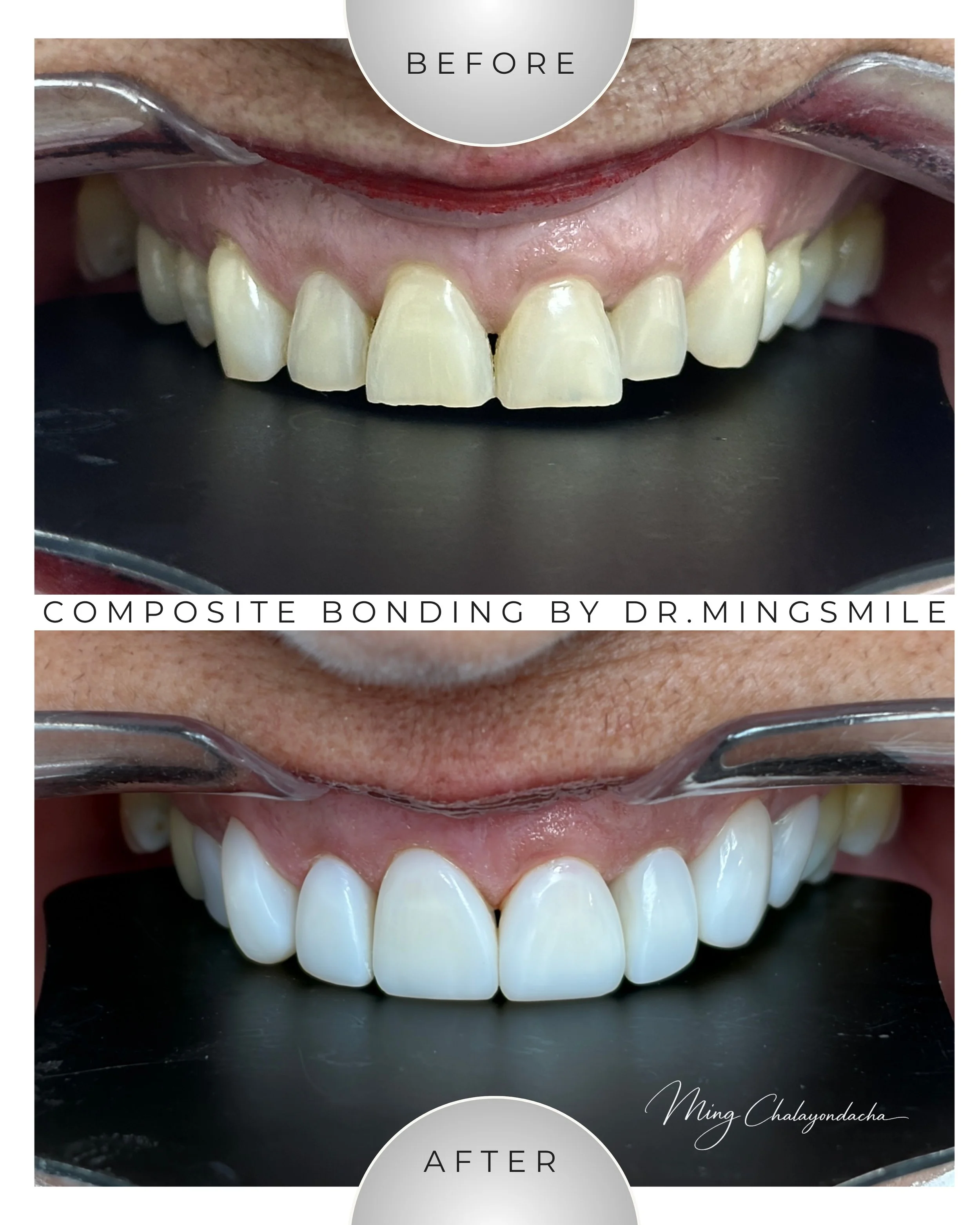 Comparison of teeth before and after composite bonding procedure. The top image shows teeth with gaps and uneven edges, while the bottom image shows teeth that are whiter, more aligned, and with gaps closed as a result of dental work by Dr. Mingsmile