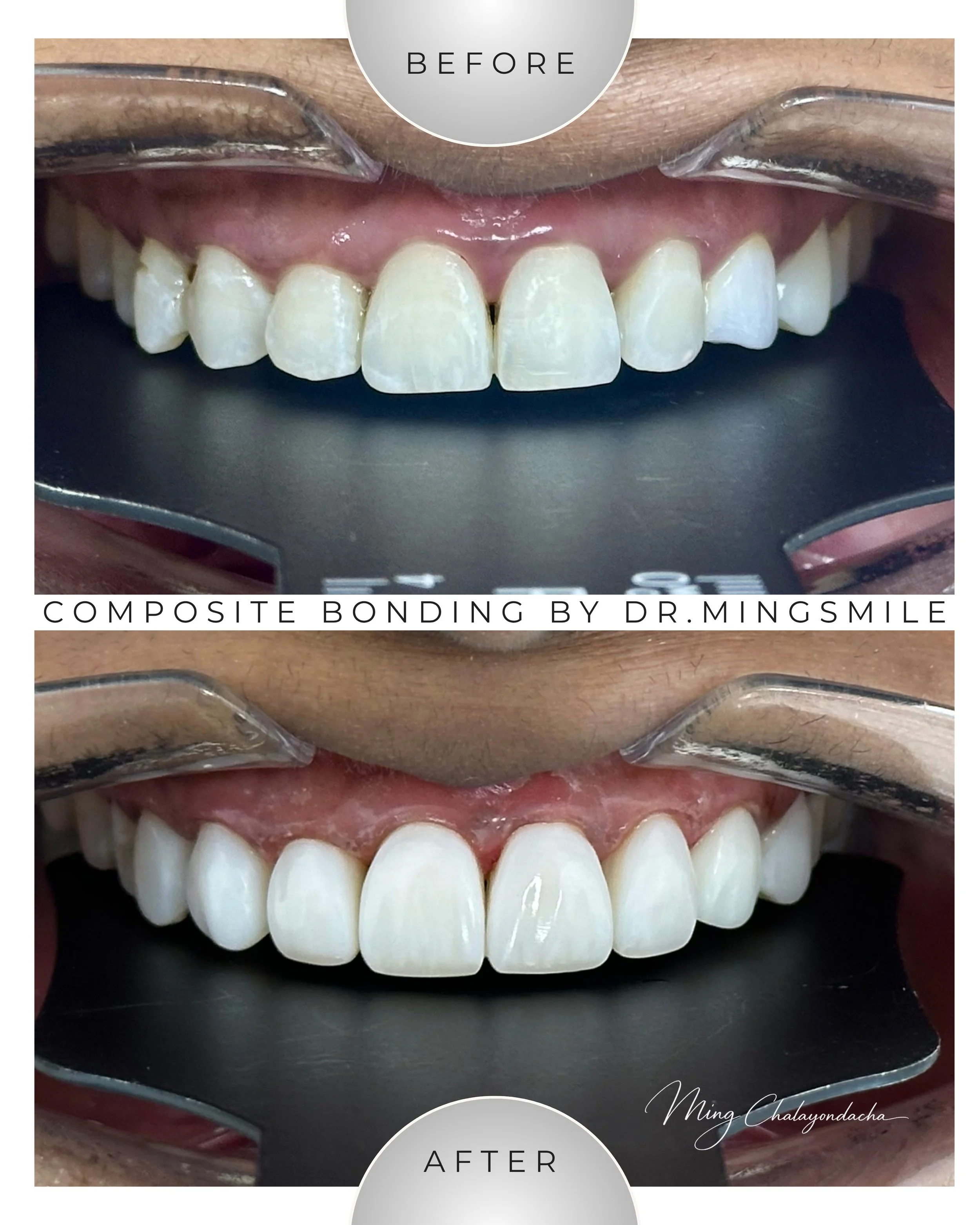 Close-up of a person's upper teeth before and after composite bonding dental procedure, with the top image showing misaligned teeth and the bottom image showing straightened teeth after treatment.