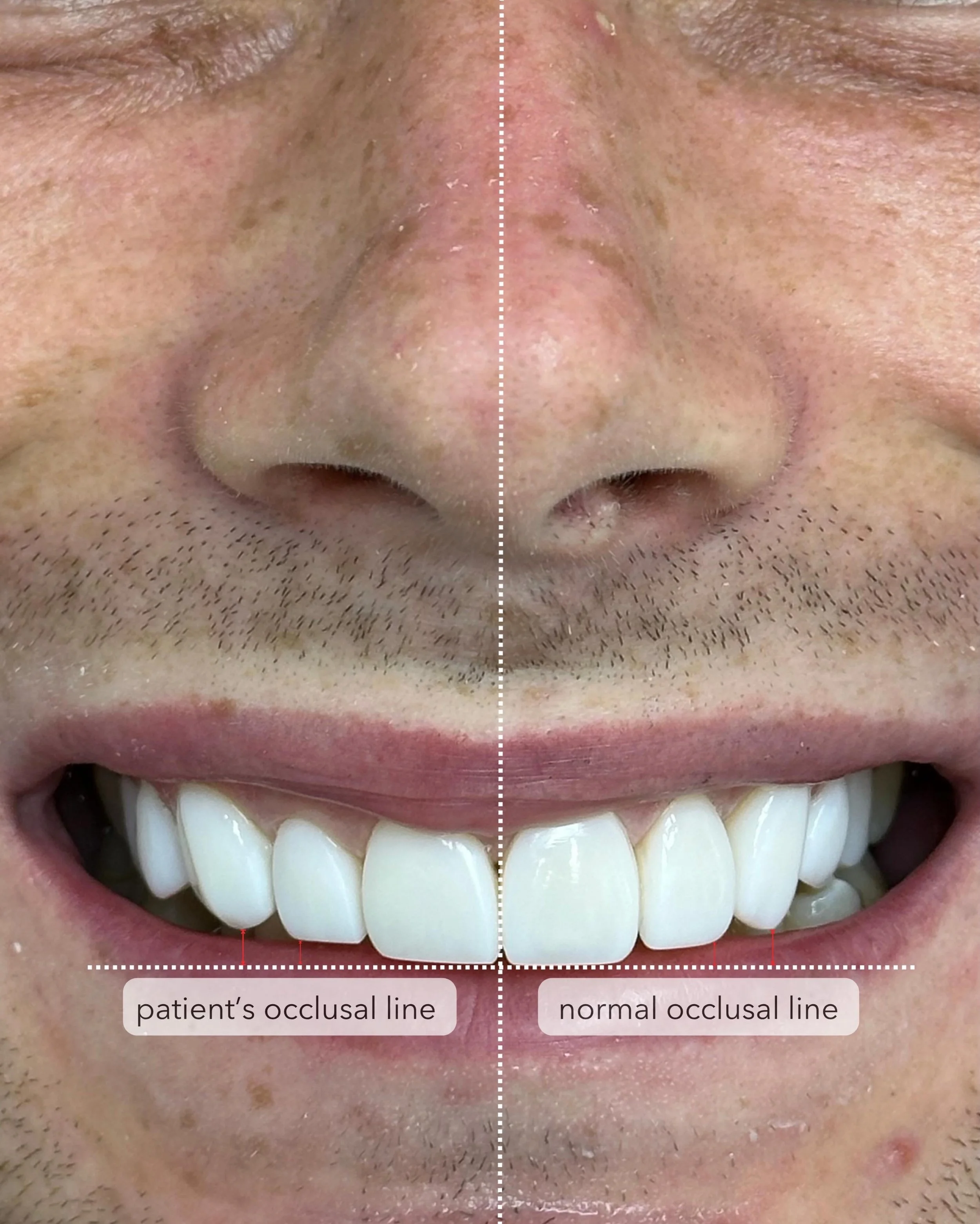 Close-up image of a person's smile showing teeth, with a dotted line dividing the image into two sides: the left labeled 'patient's occlusal line' and the right labeled 'normal occlusal line'.