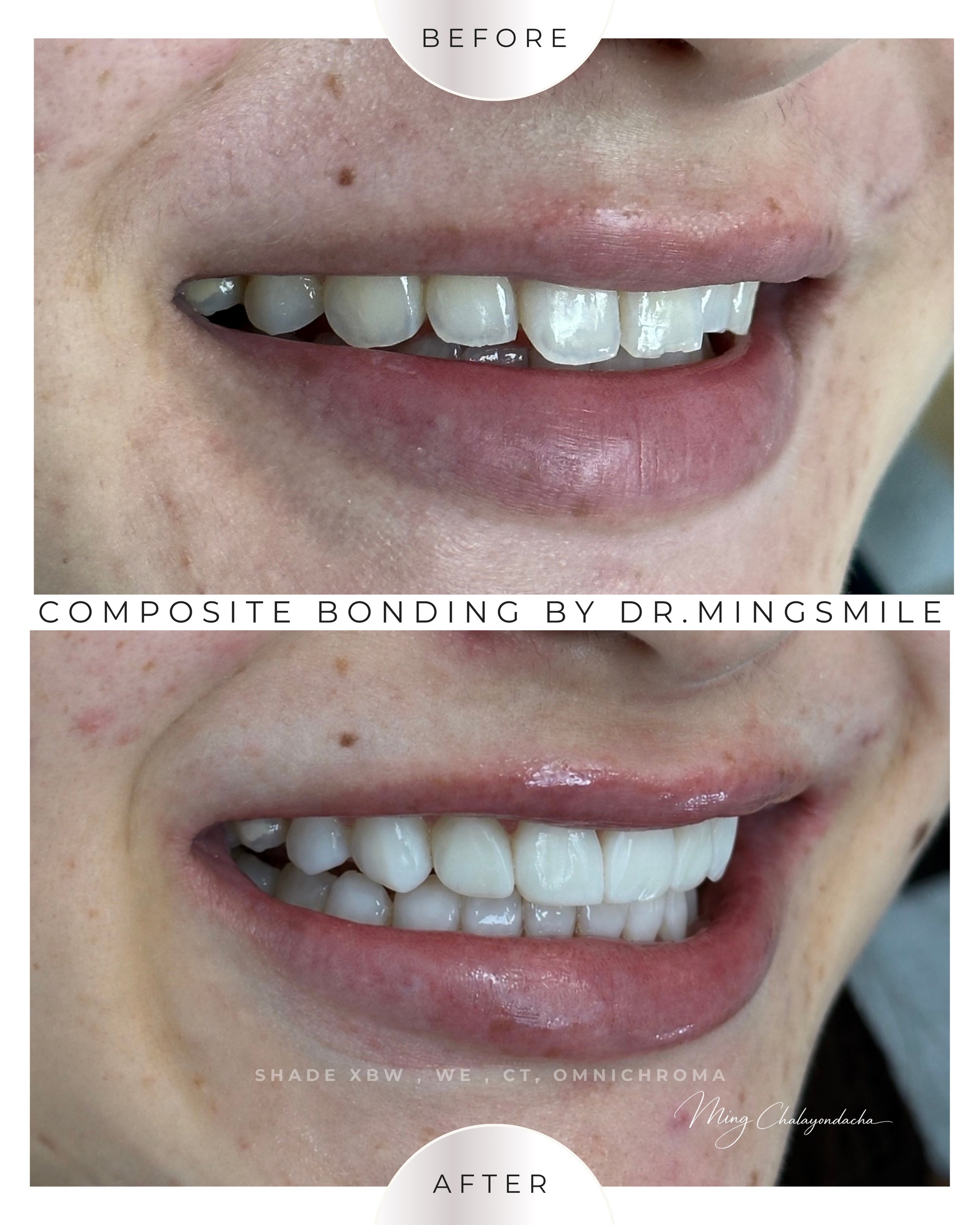 Close-up of a smiling person's teeth showing a before-and-after comparison of composite bonding done by Dr. Mingsmile, with the after image displaying whiter, straighter teeth.