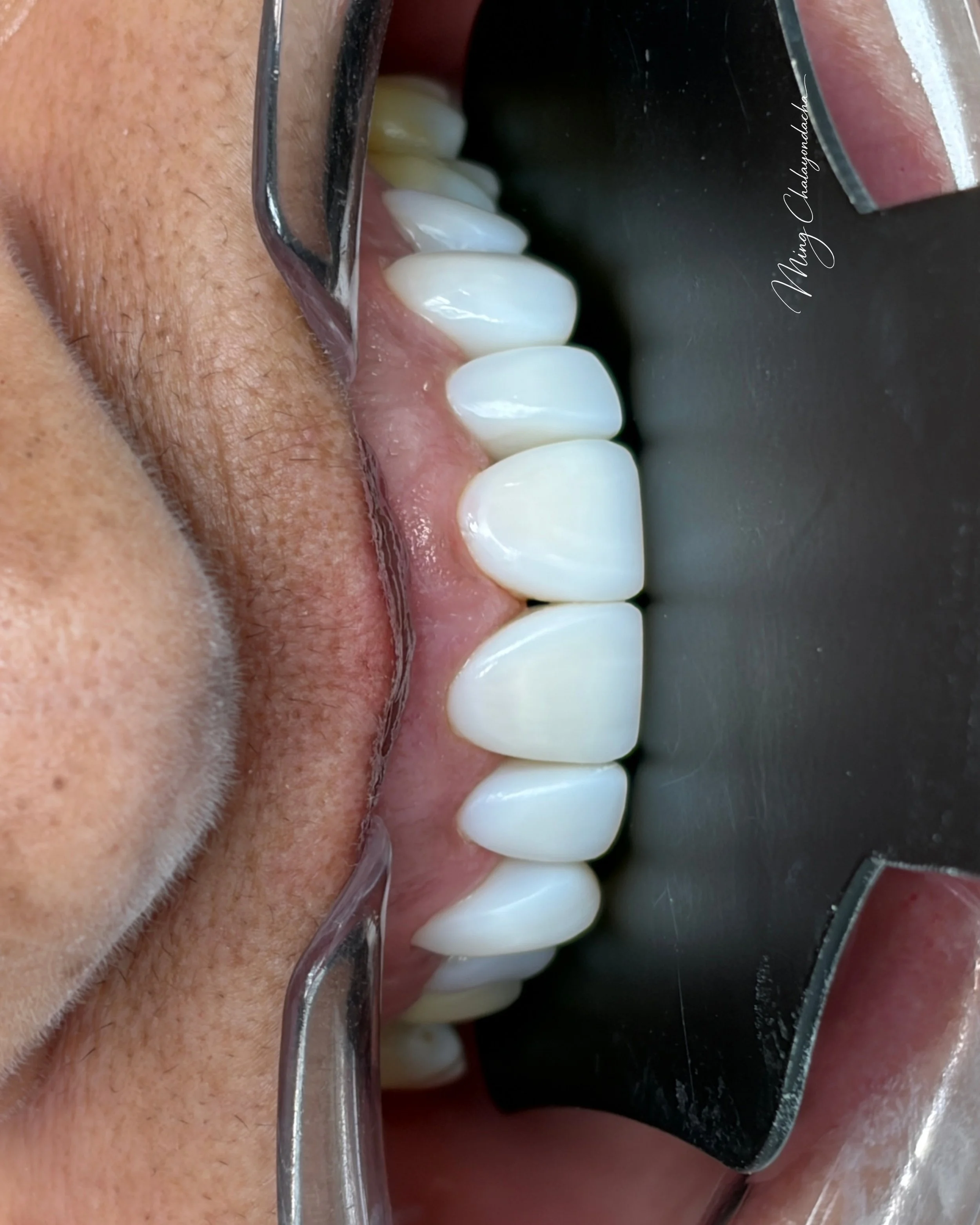 Close-up of a person's mouth with white teeth. Dental mirror reflects teeth and gums inside the mouth. The image appears to be in a dental clinic setting.