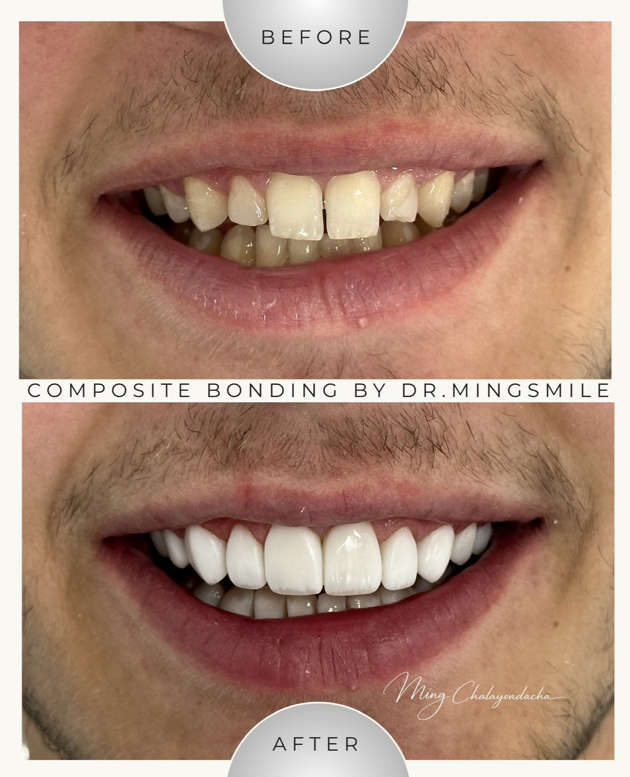 Comparison of a person's smile before and after dental composite bonding. The before shows crooked, discolored, and chipped teeth, while the after displays straight, white, and even teeth. The bottom of the image credits Dr. Mingsmile for the dental work.