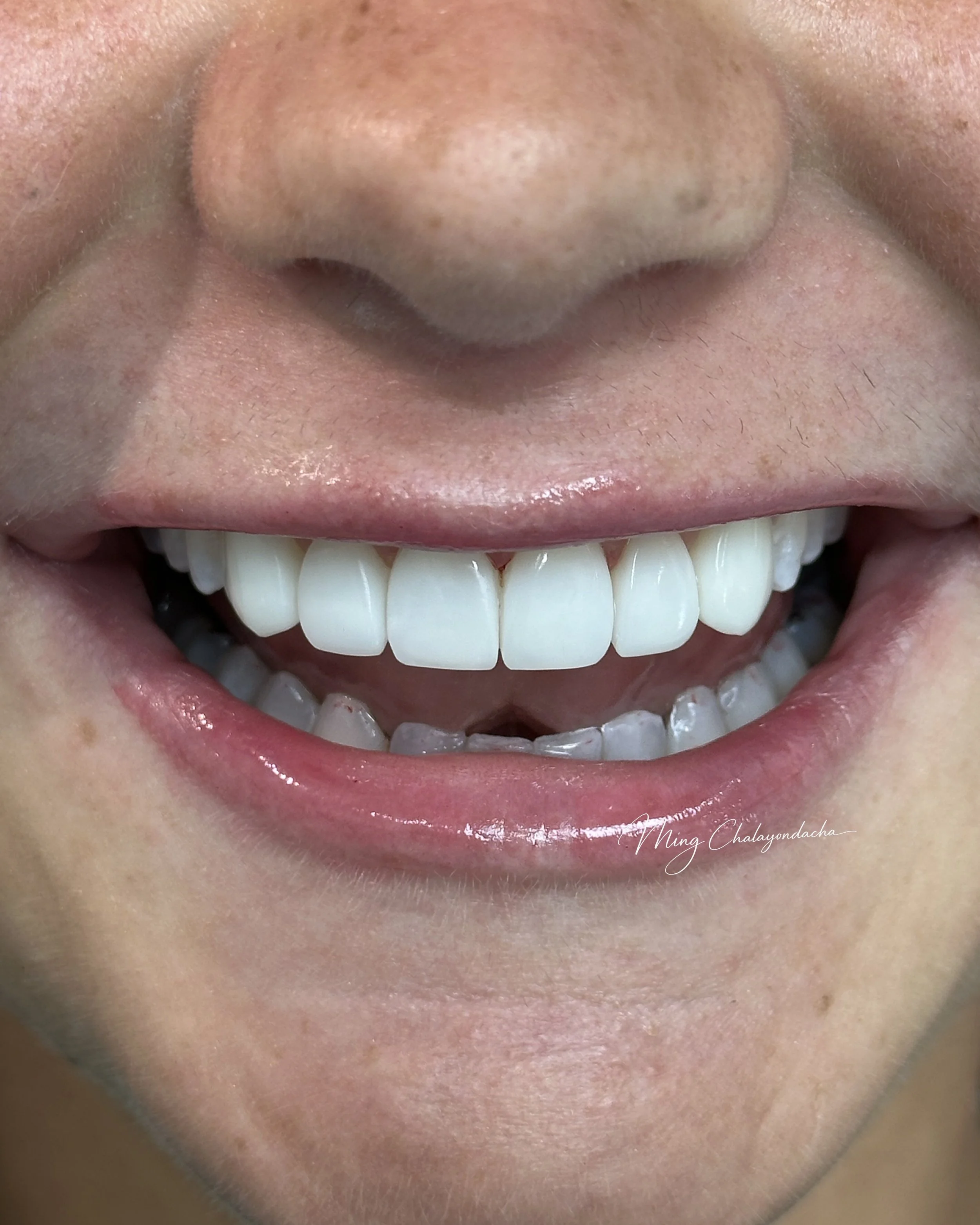 Close-up of a smiling person showing their teeth, pink lips, and part of their nose and cheeks.