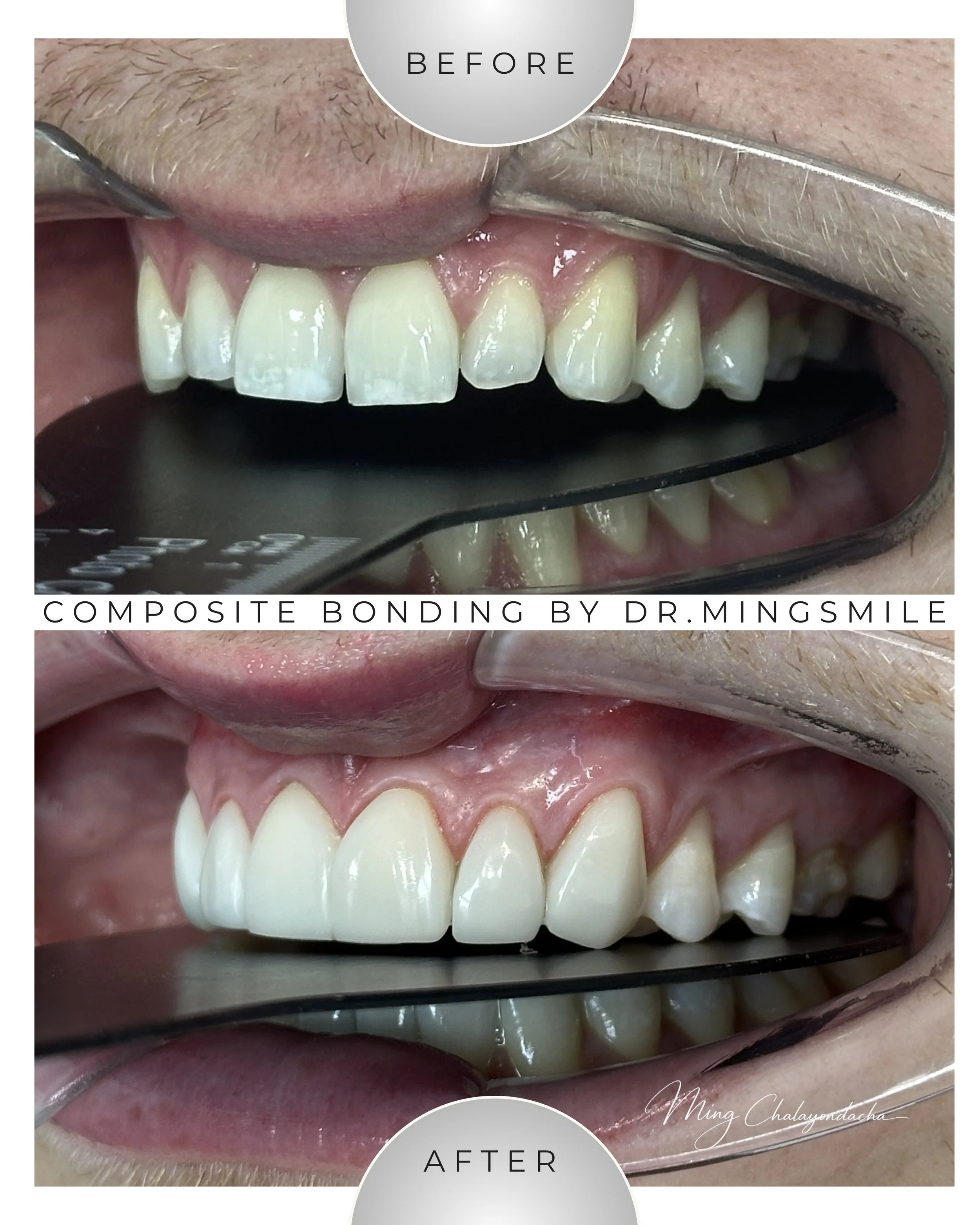 Close-up of a person's upper teeth before and after composite bonding, with dental tools and a mirror showing improved tooth appearance.