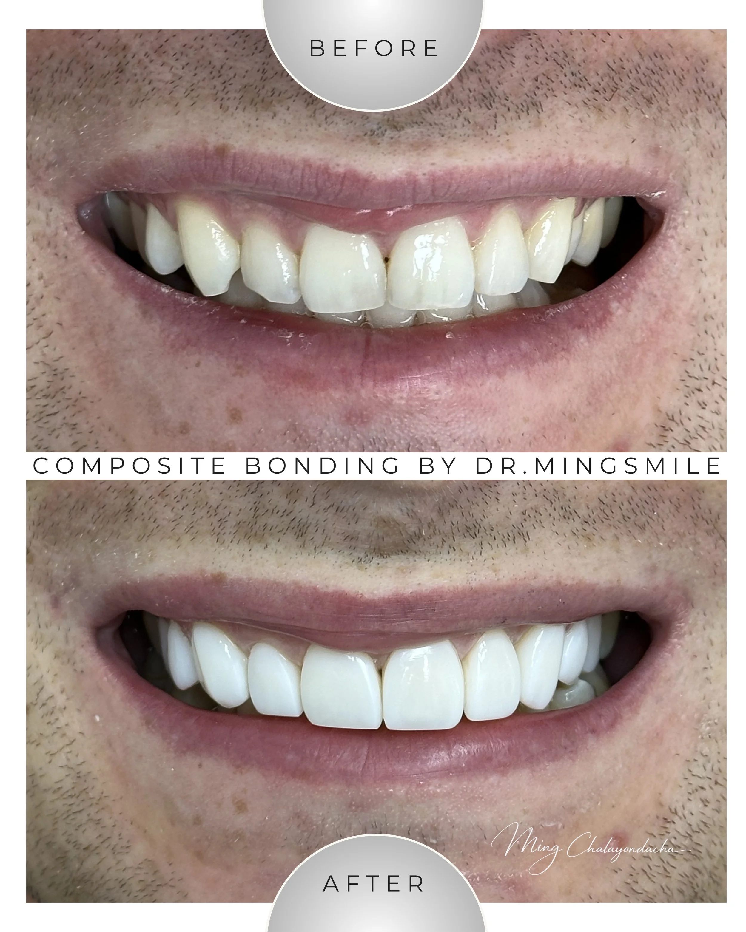 Comparison of a person's teeth before and after composite bonding, showing improved alignment and appearance.