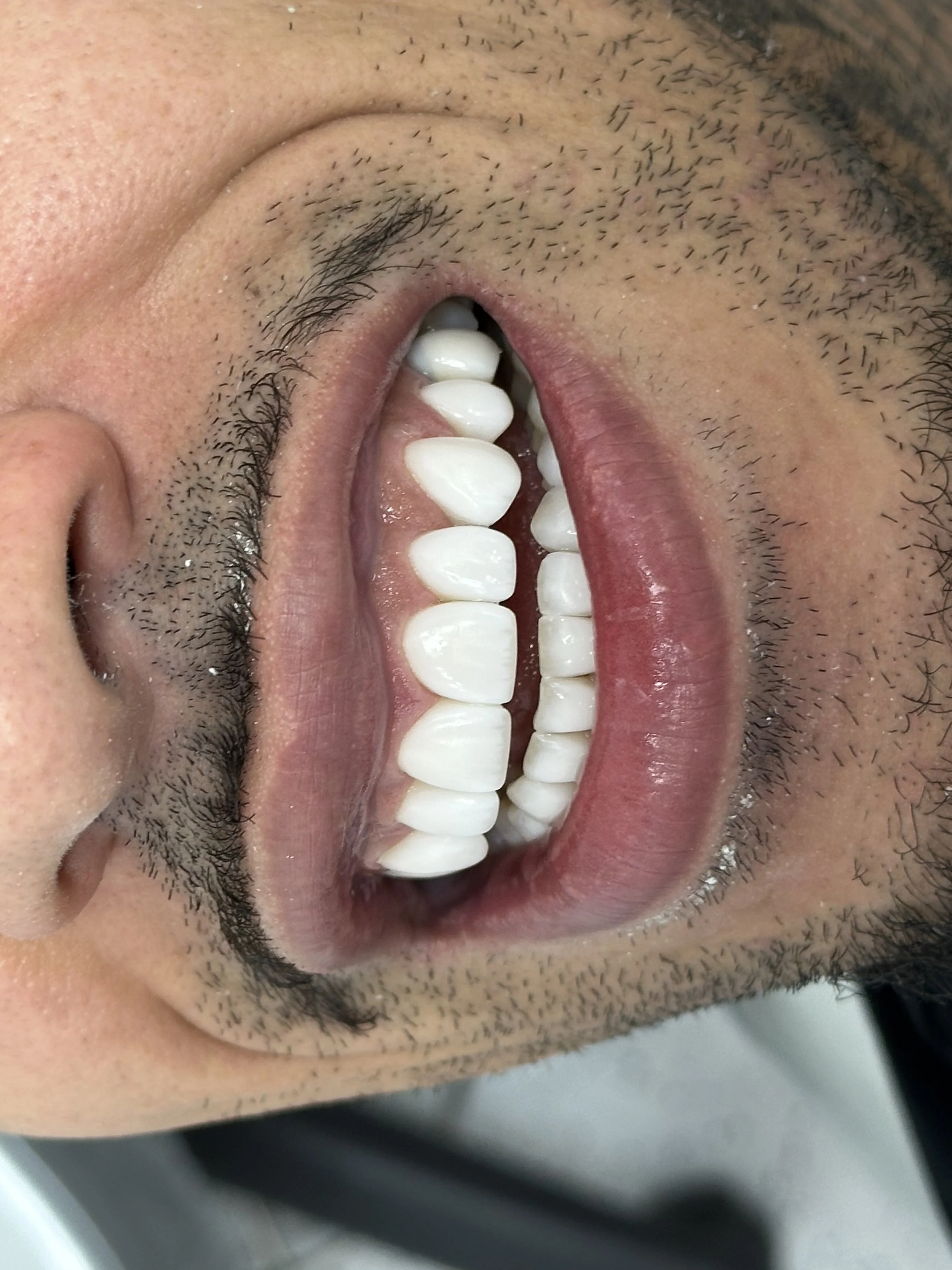 A close-up of a person's open mouth showing teeth, gums, and tongue, with facial hair around the mouth.