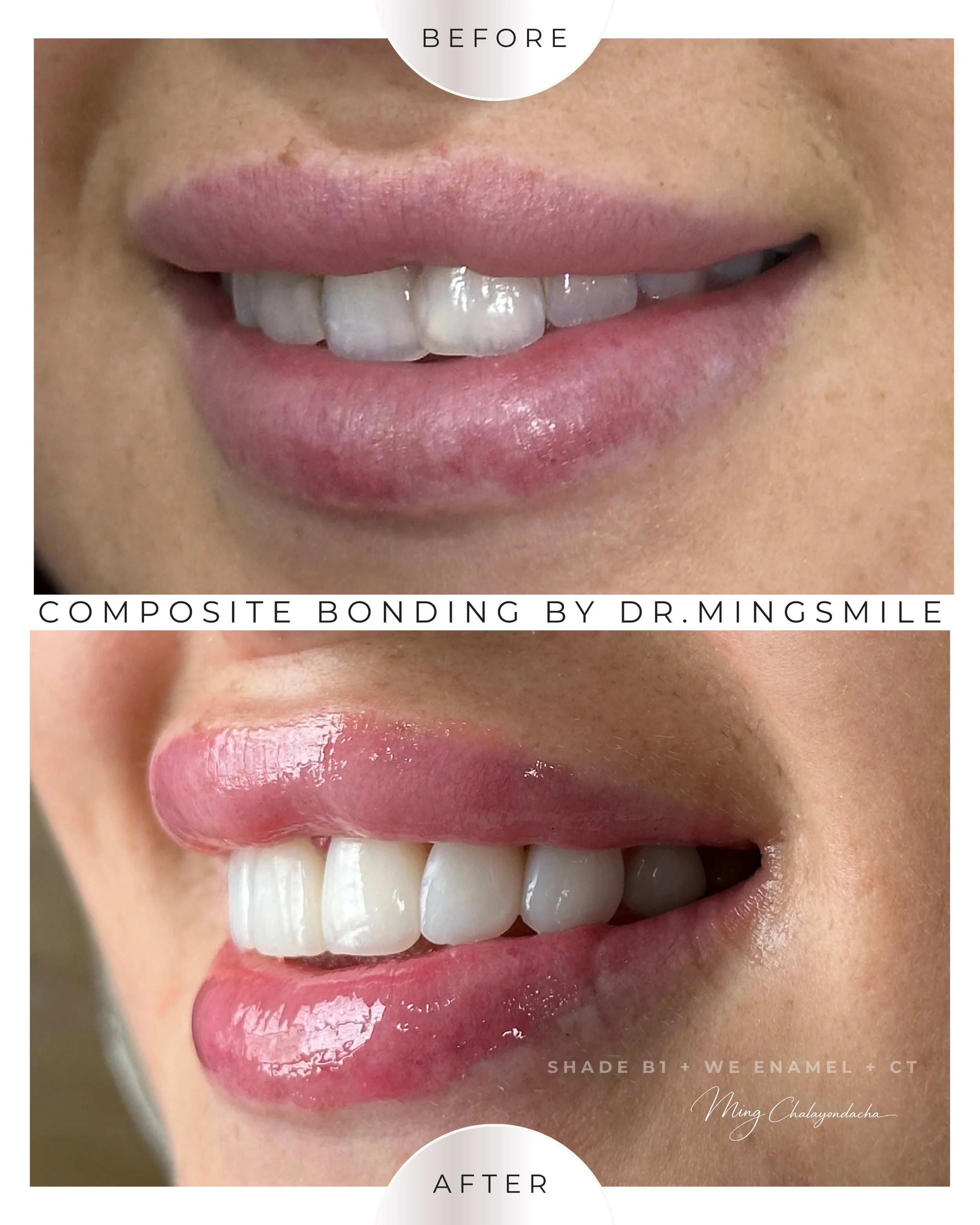 Close-up of a smiling person's mouth showing teeth and lips, with a before and after comparison of tooth bonding procedure. The upper part labeled 'BEFORE' shows teeth with natural color, and the lower part labeled 'AFTER' shows teeth with a shiny, e