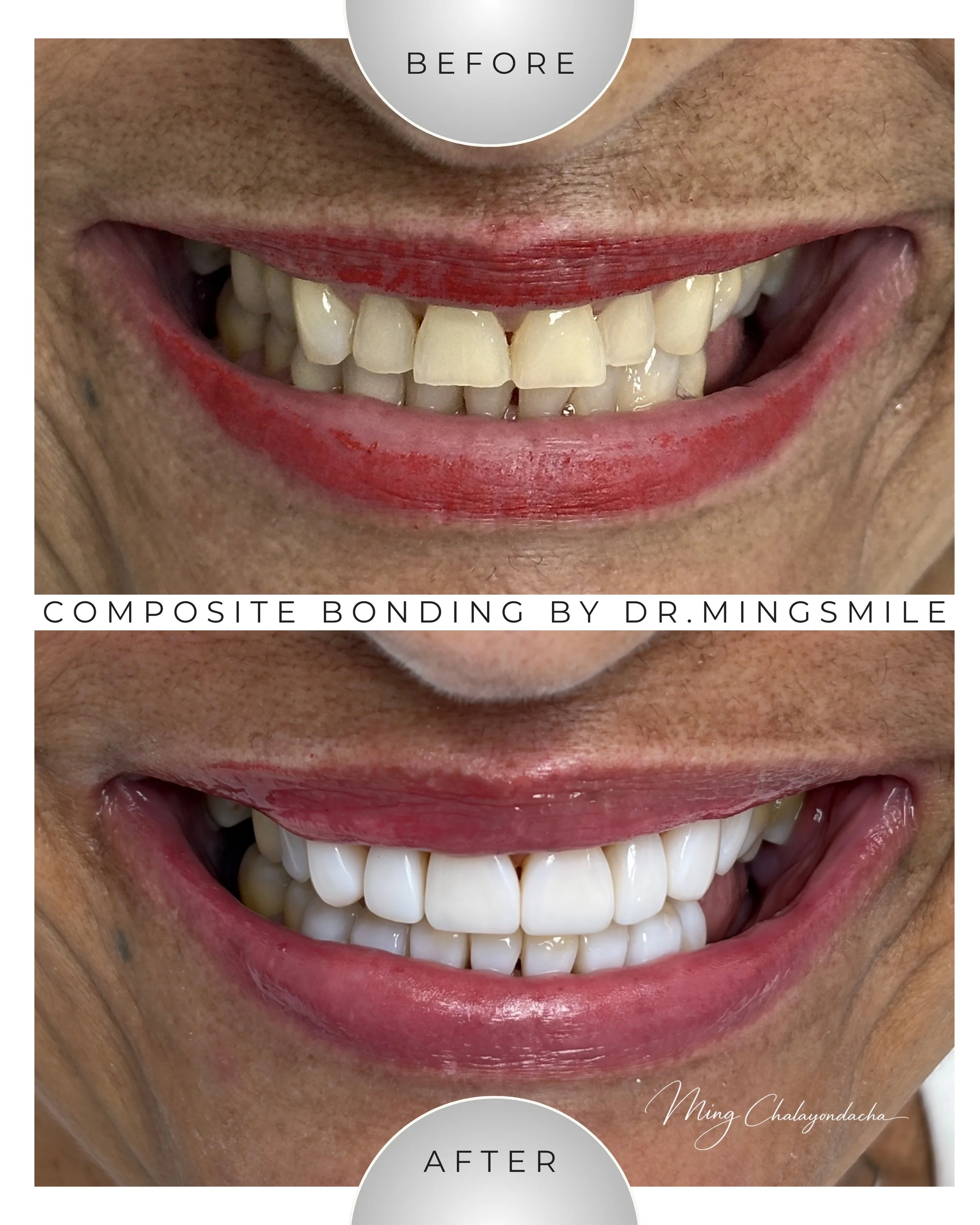 Close-up of a person's smiling mouth showing before and after dental composite bonding, with the 'before' image at the top and 'after' at the bottom.