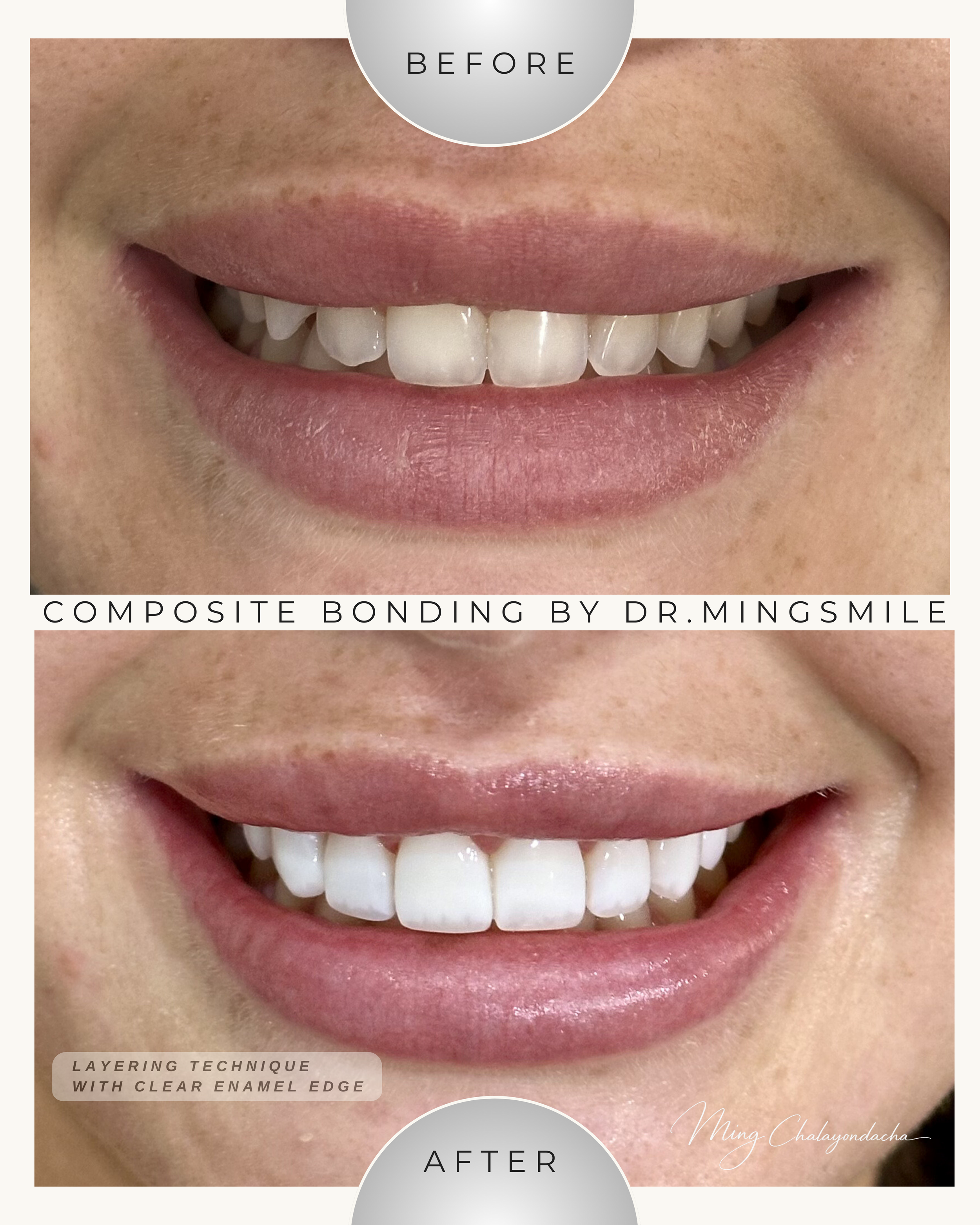 Close-up photo of a person's smile showing a transition from yellowed, uneven teeth to white, evenly aligned teeth after dental composite bonding. The image compares before and after results, highlighting improved dental appearance.