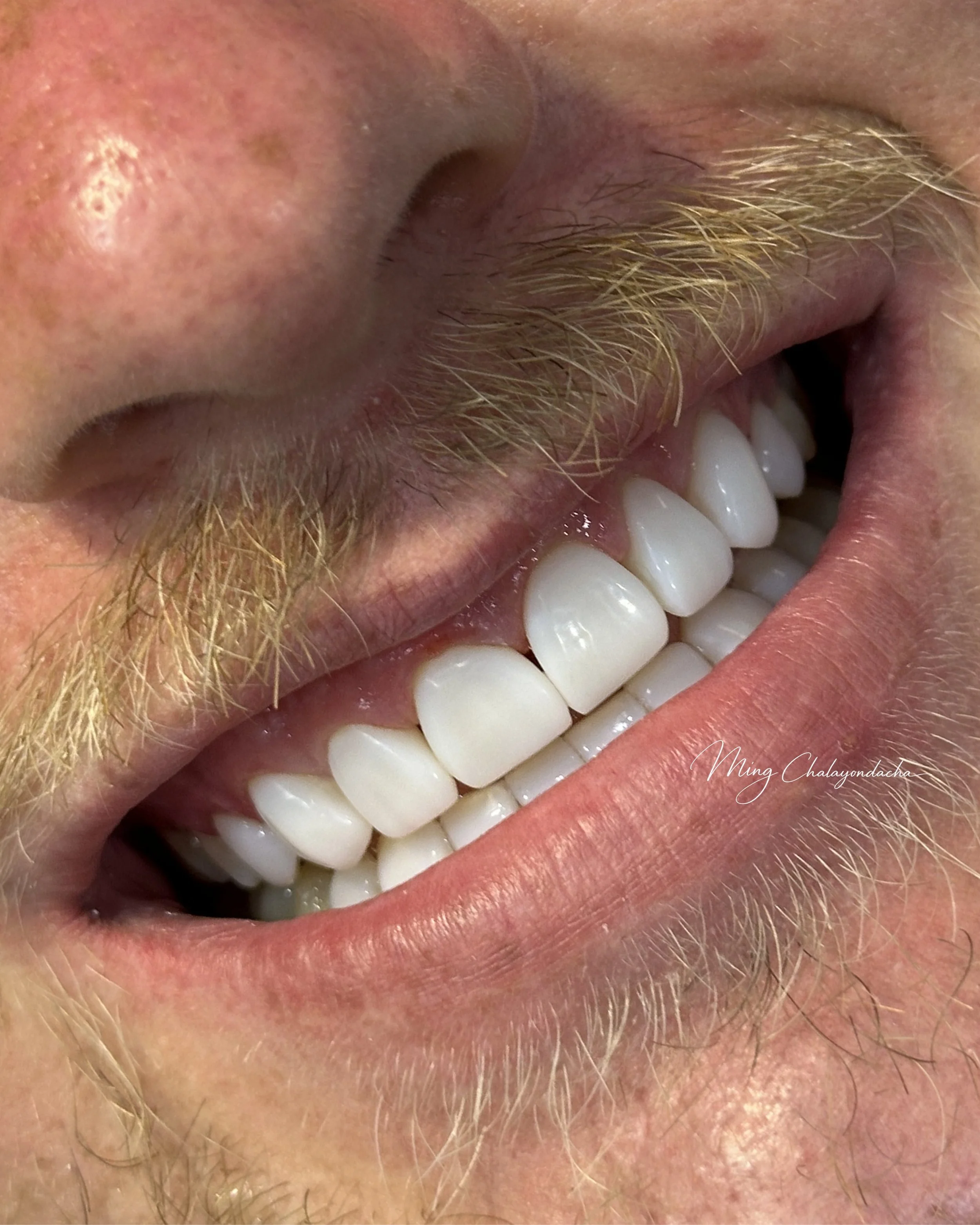 Close-up of a person's face showing part of their nose, mustache, and mouth, with visible teeth and some facial skin and hair.