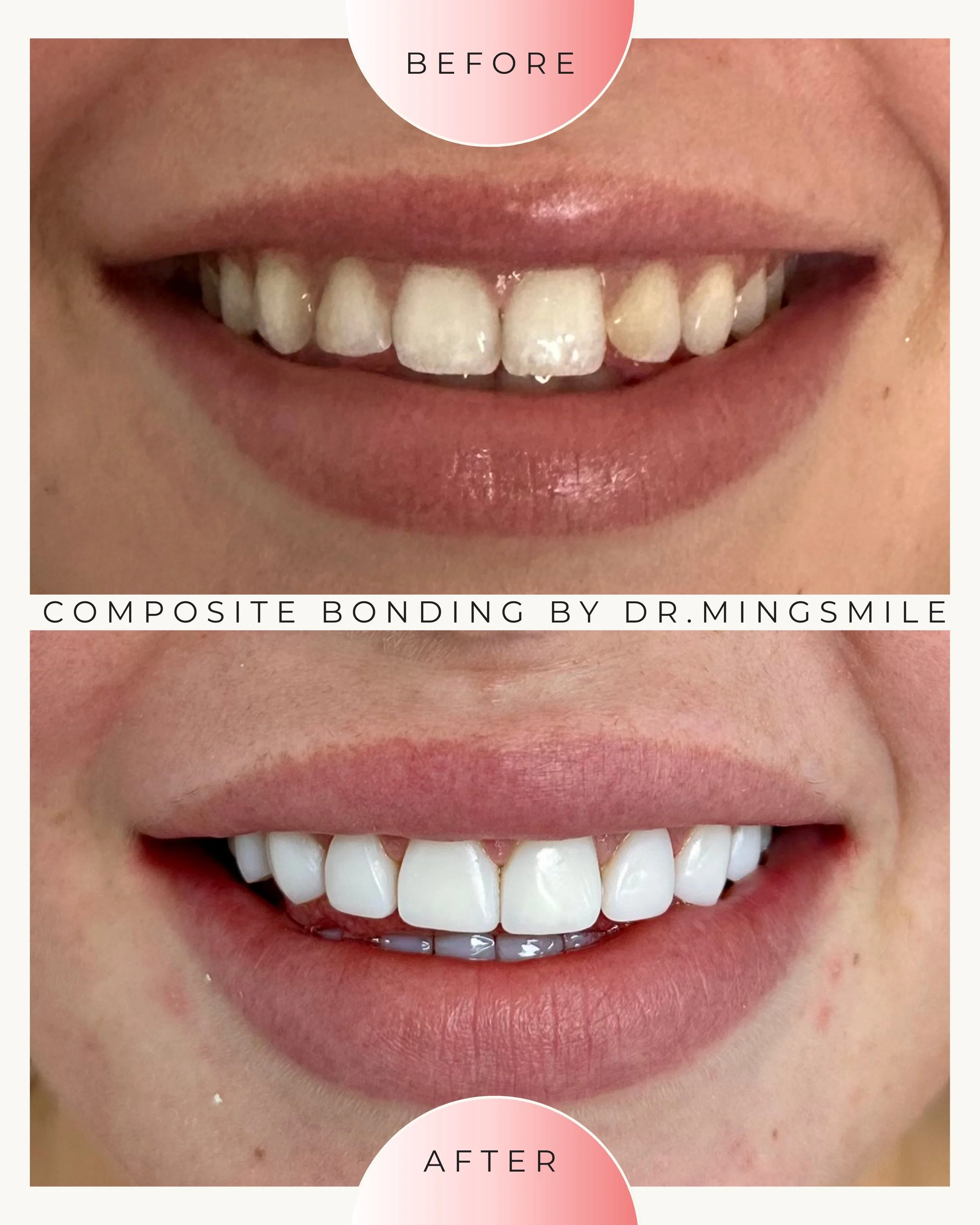 Close-up photo of a person's smile showing teeth before and after composite bonding, with a noticeable difference in tooth appearance.