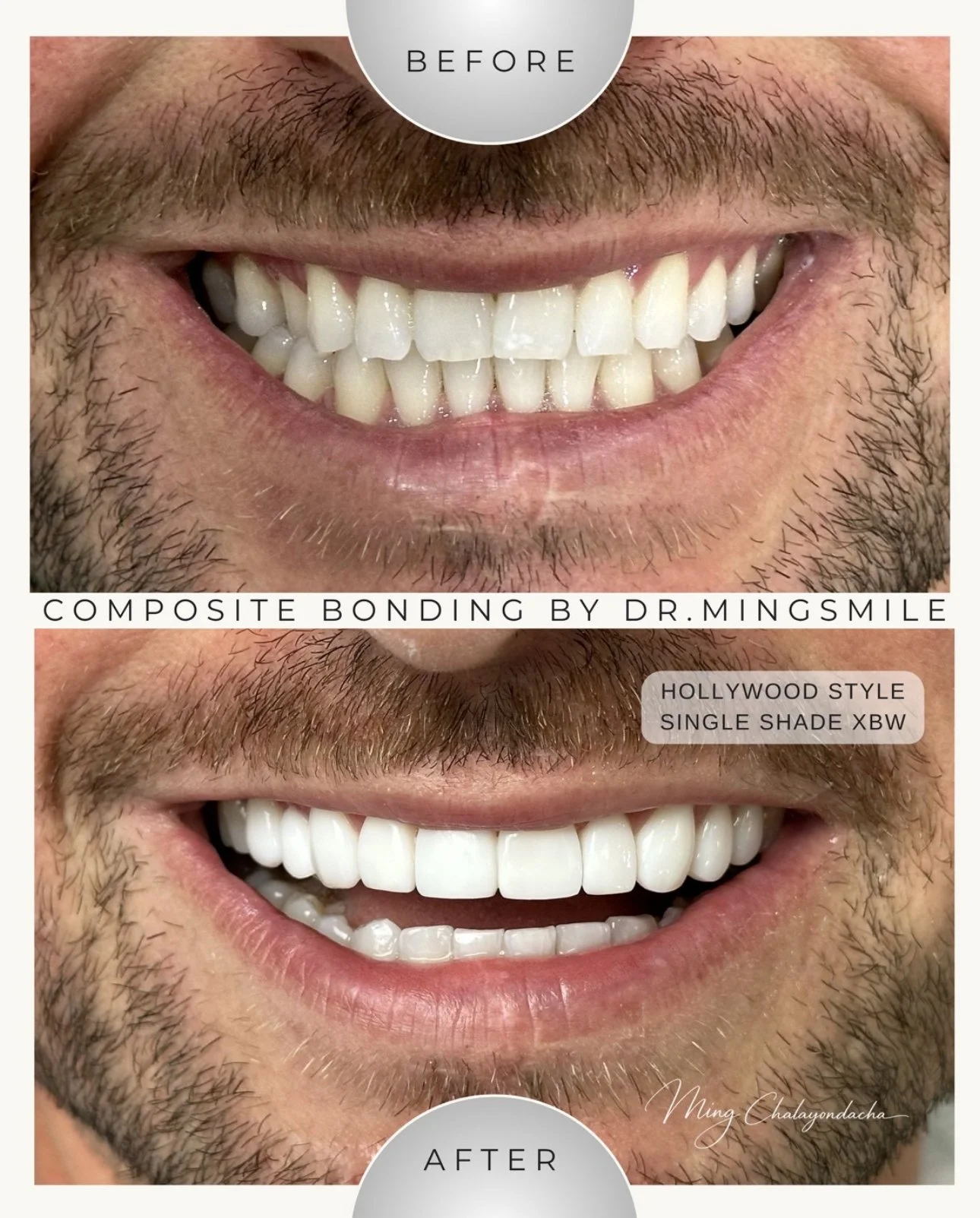 Comparison of a person's teeth before and after dental bonding treatment, showing whiter, more even teeth in the after image.