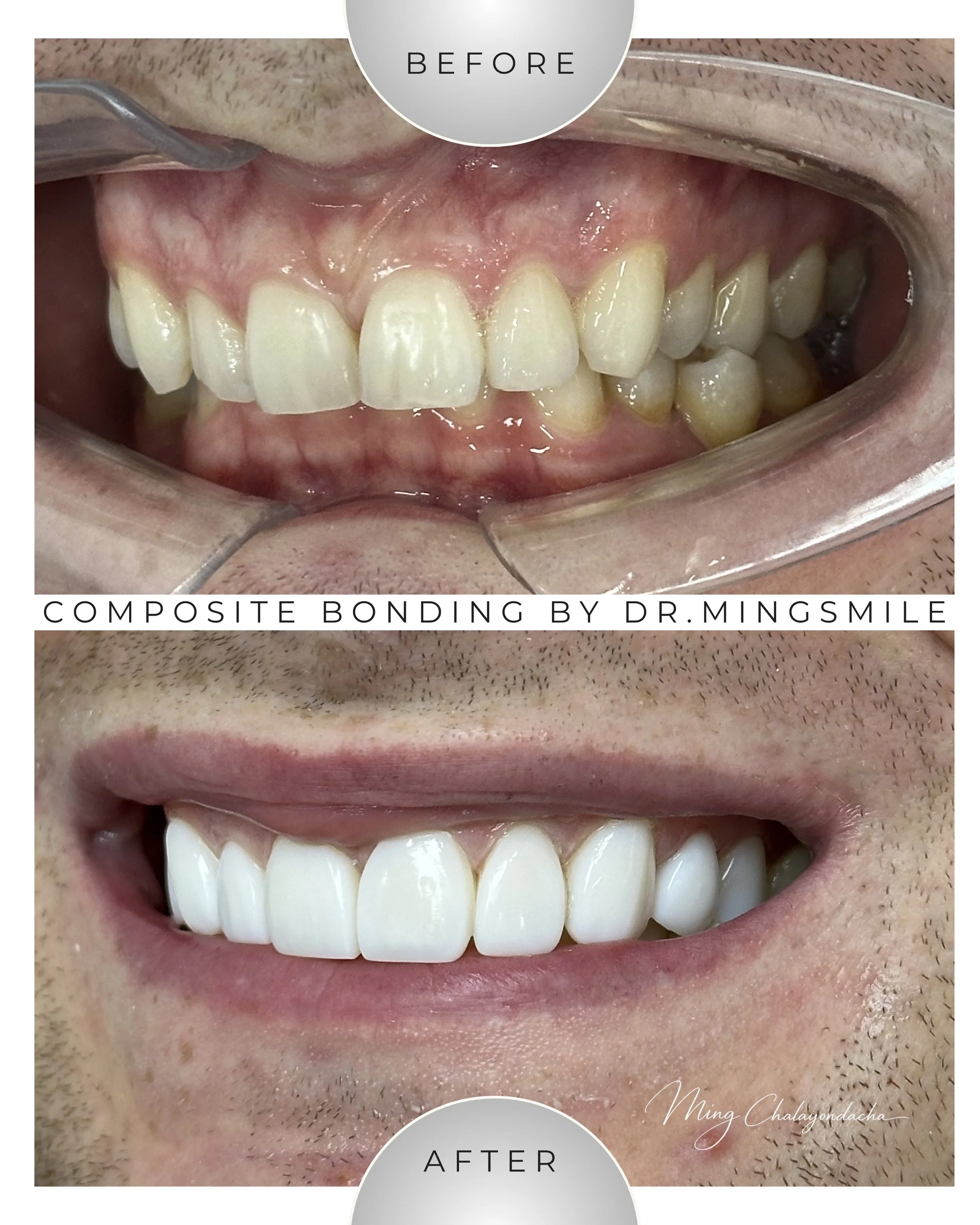 Close-up of a person's mouth showing teeth before and after composite bonding procedure, with the upper teeth appearing more aligned and improved in the after image.