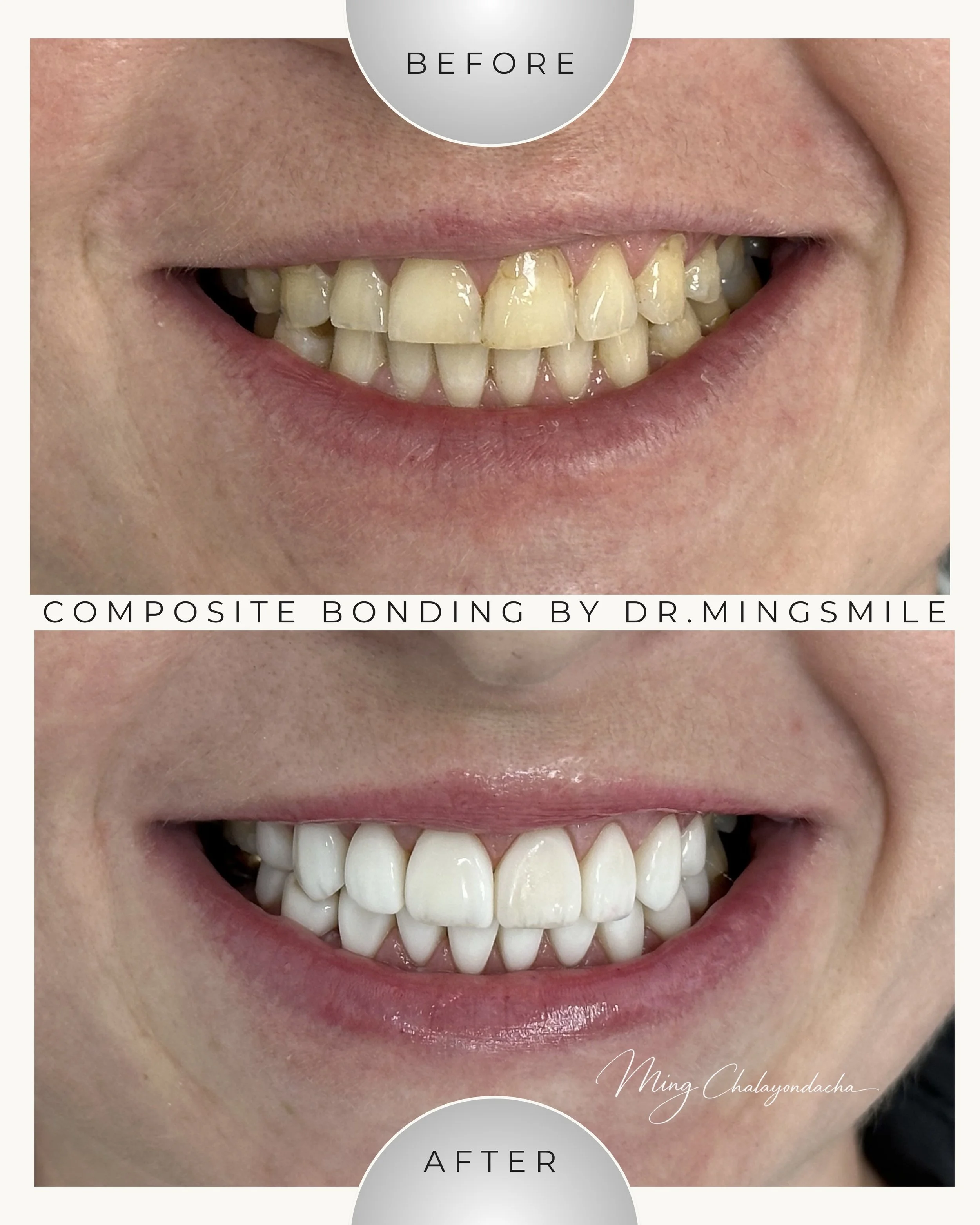 Before and after images of dental composite bonding showing improved tooth alignment and appearance by Dr. Mingsmile.
