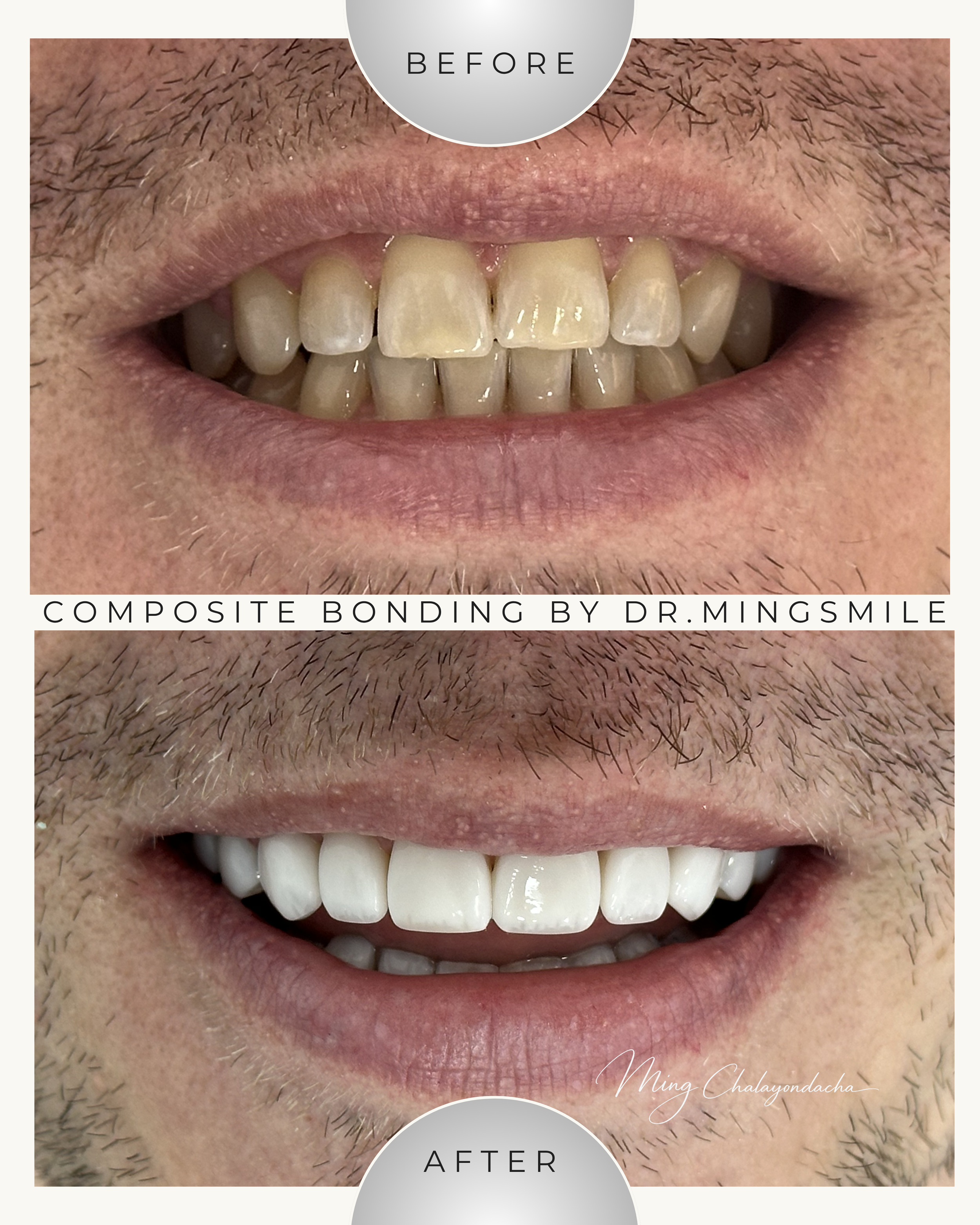 Close-up of a person's mouth showing before and after dental composite bonding; the 'before' image shows discolored and uneven teeth, the 'after' image displays whiter, even teeth with a natural appearance.