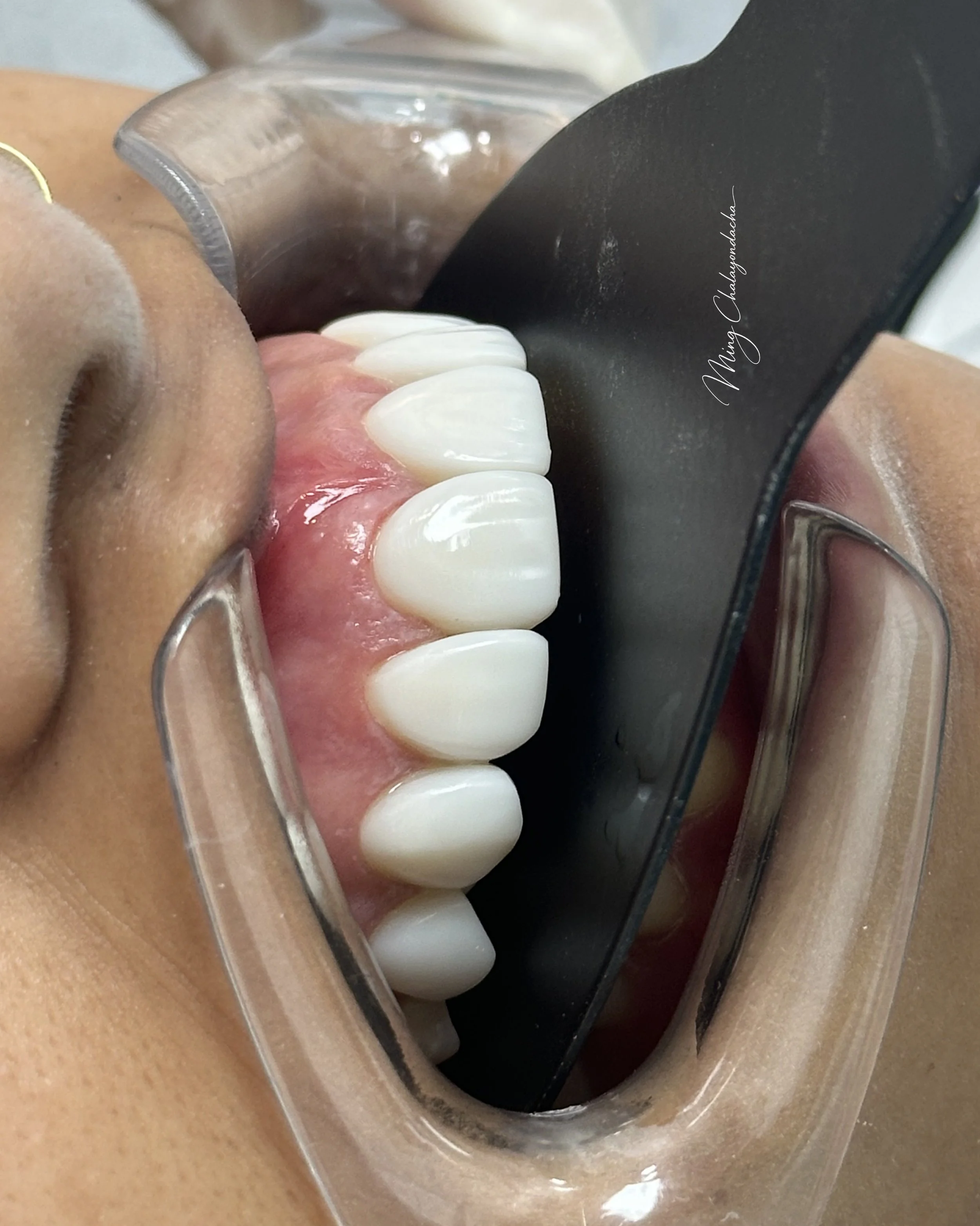 Close-up of a dental impression tray with teeth and gums, black and clear plastic, resting on a person's skin.